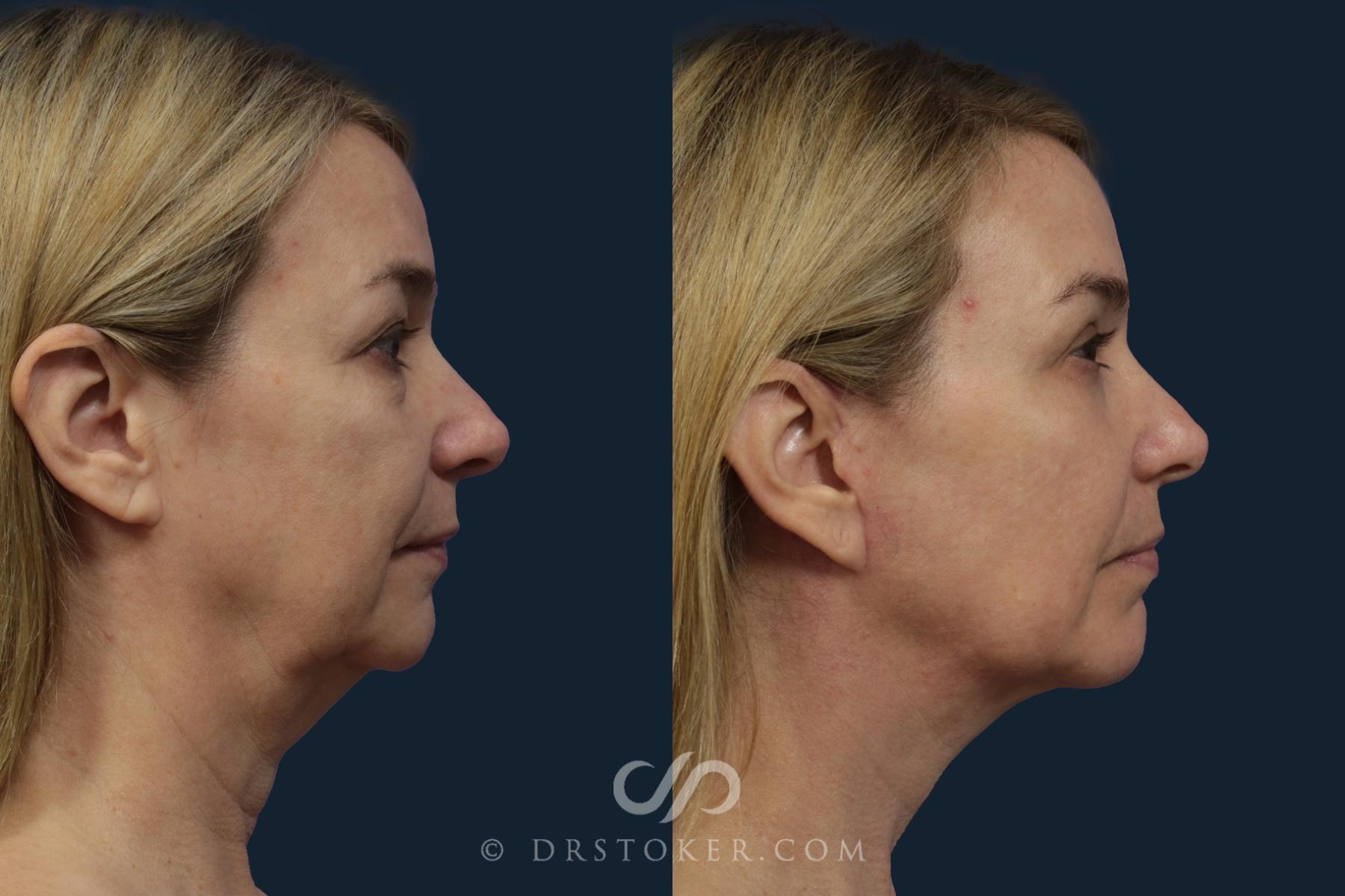 Before & After Facelift/Neck Lift (Deep Plane/Traceless) Case 2126 Right Side View in Los Angeles, CA