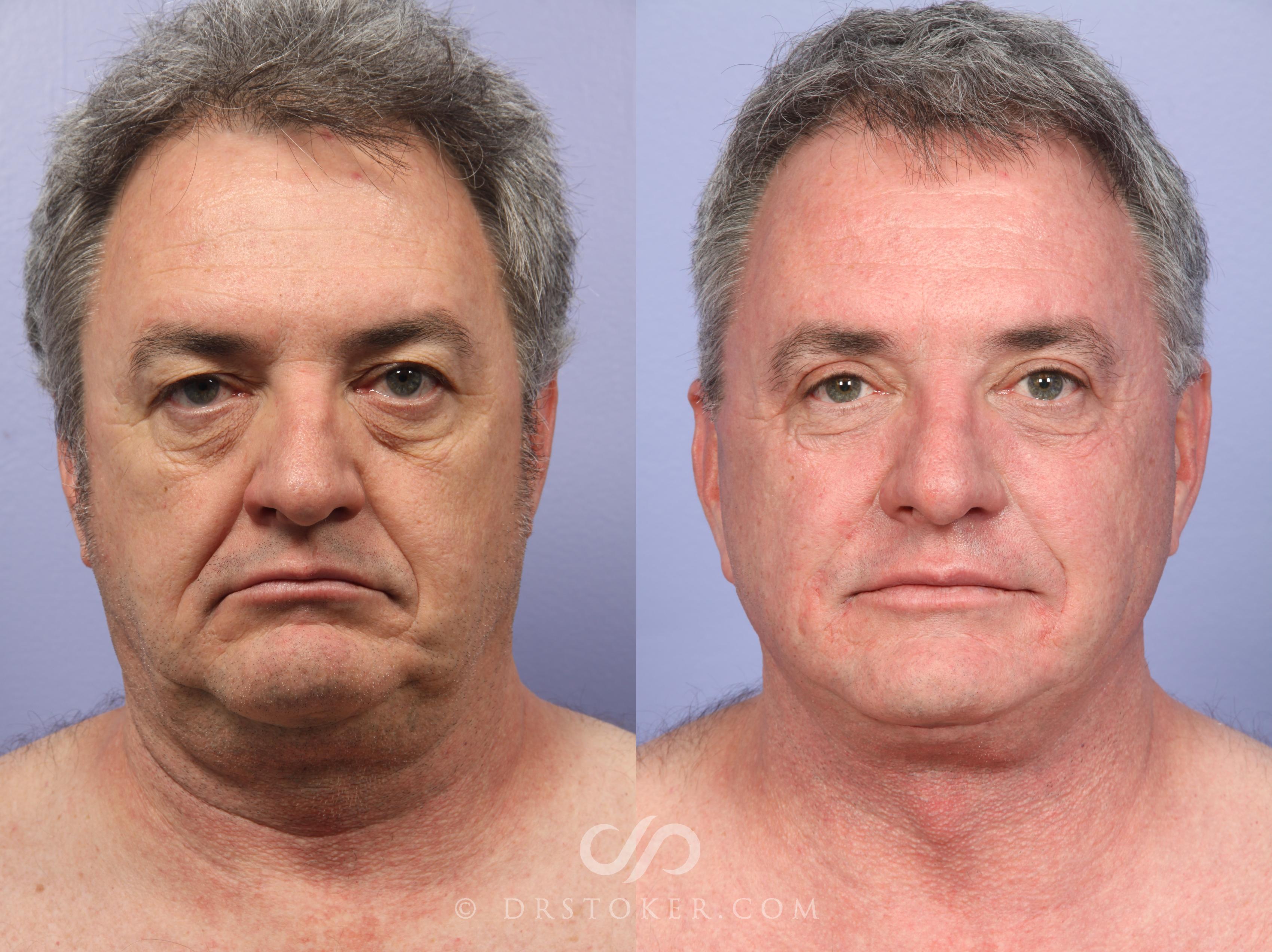 Before & After Facelift/Neck Lift (Deep Plane/Traceless) Case 2127 Front View in Los Angeles, CA