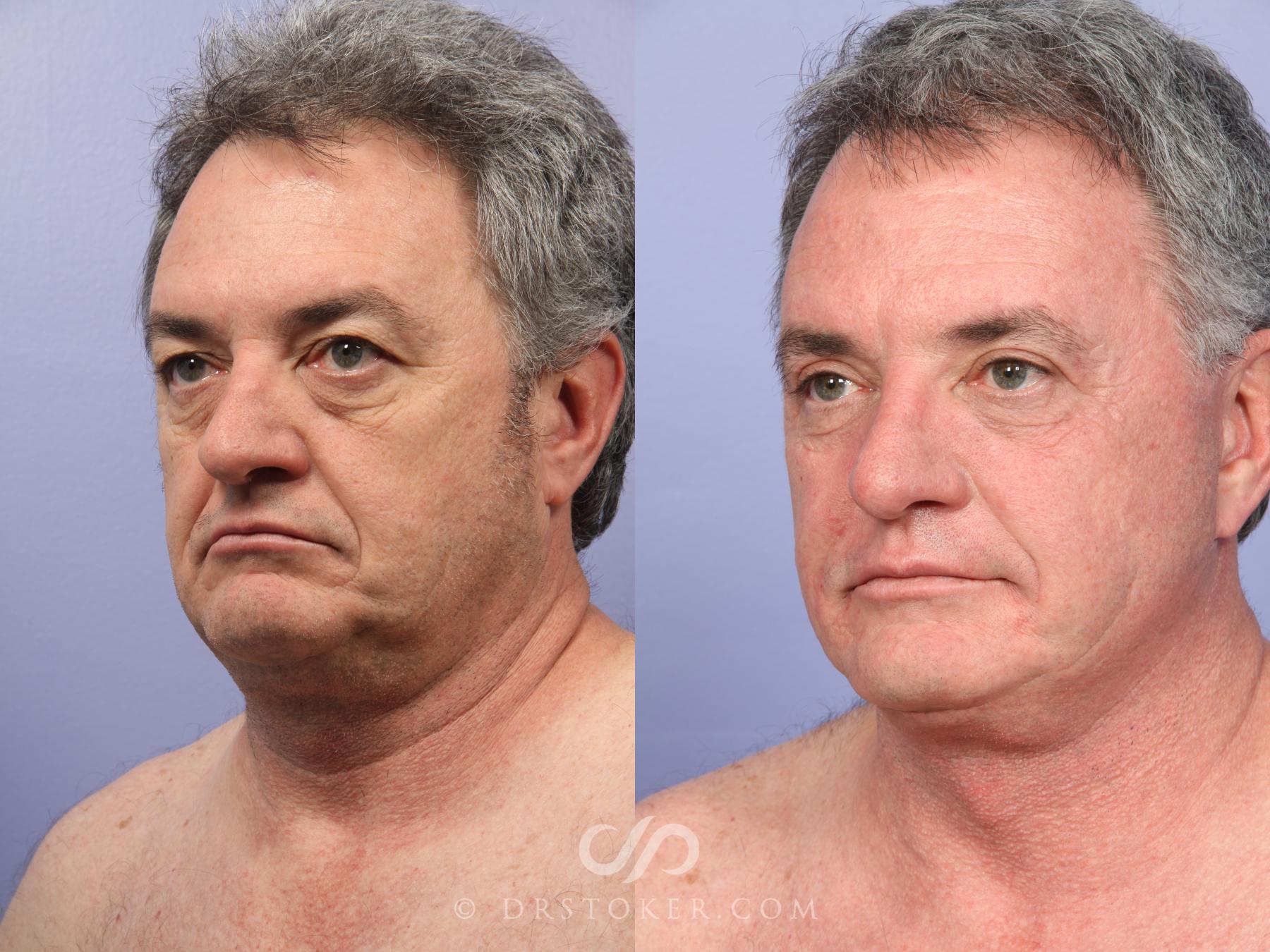 Before & After Facelift/Neck Lift (Deep Plane/Traceless) Case 2127 Left Oblique View in Los Angeles, CA