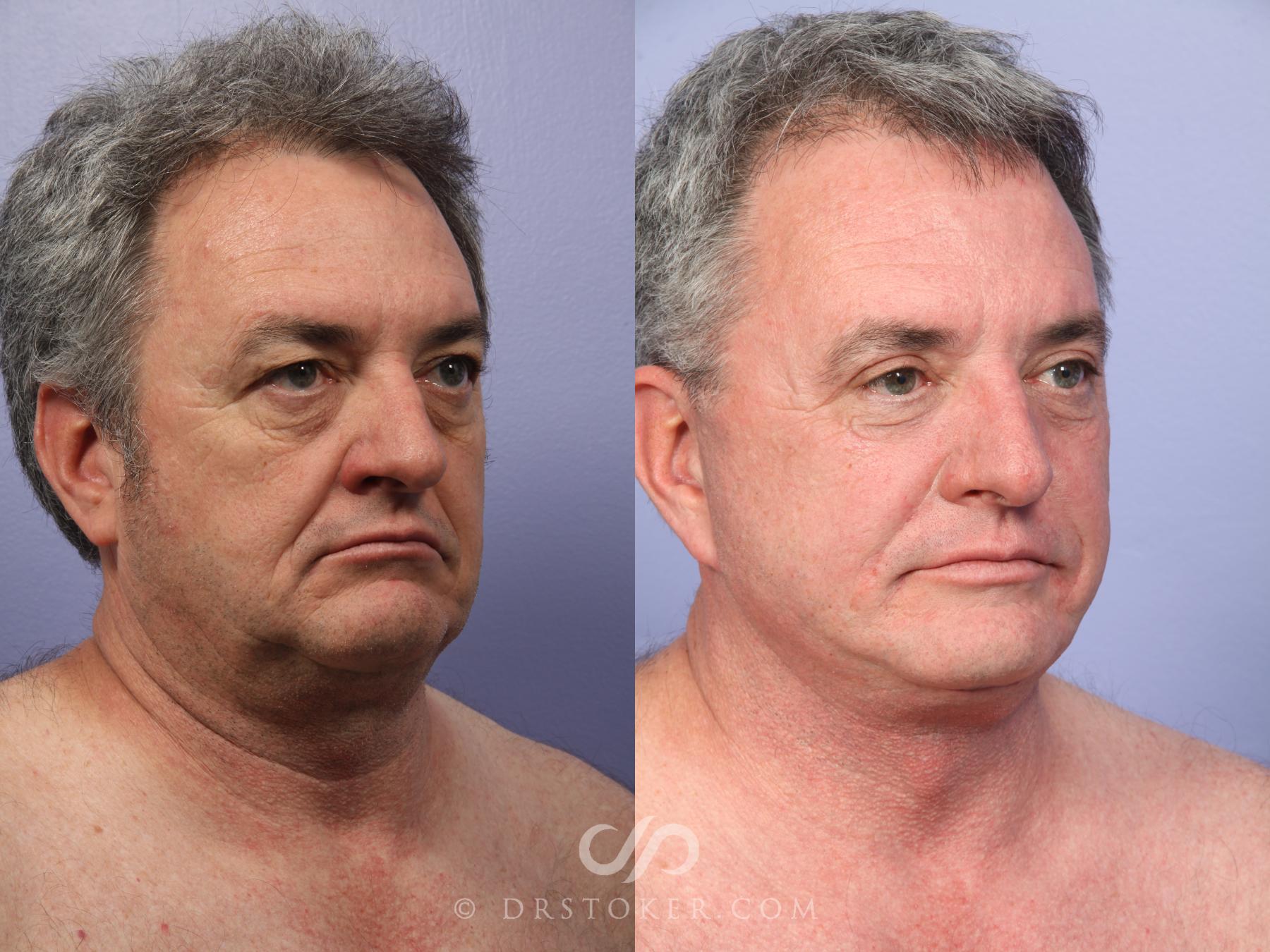Before & After Facelift/Neck Lift (Deep Plane/Traceless) Case 2127 Right Oblique View in Los Angeles, CA