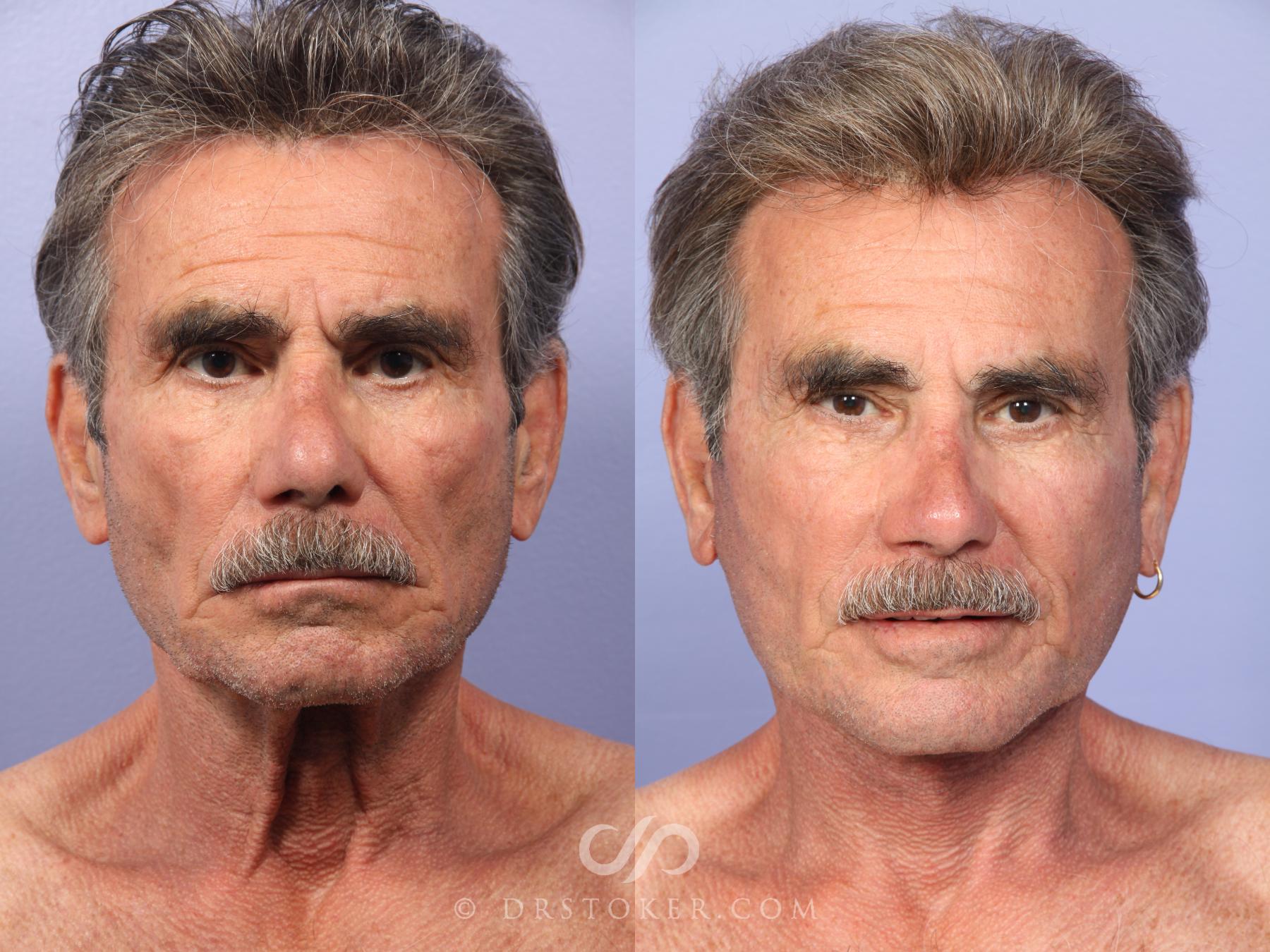 Before & After Facelift/Neck Lift (Deep Plane/Traceless) Case 2128 Front View in Los Angeles, CA