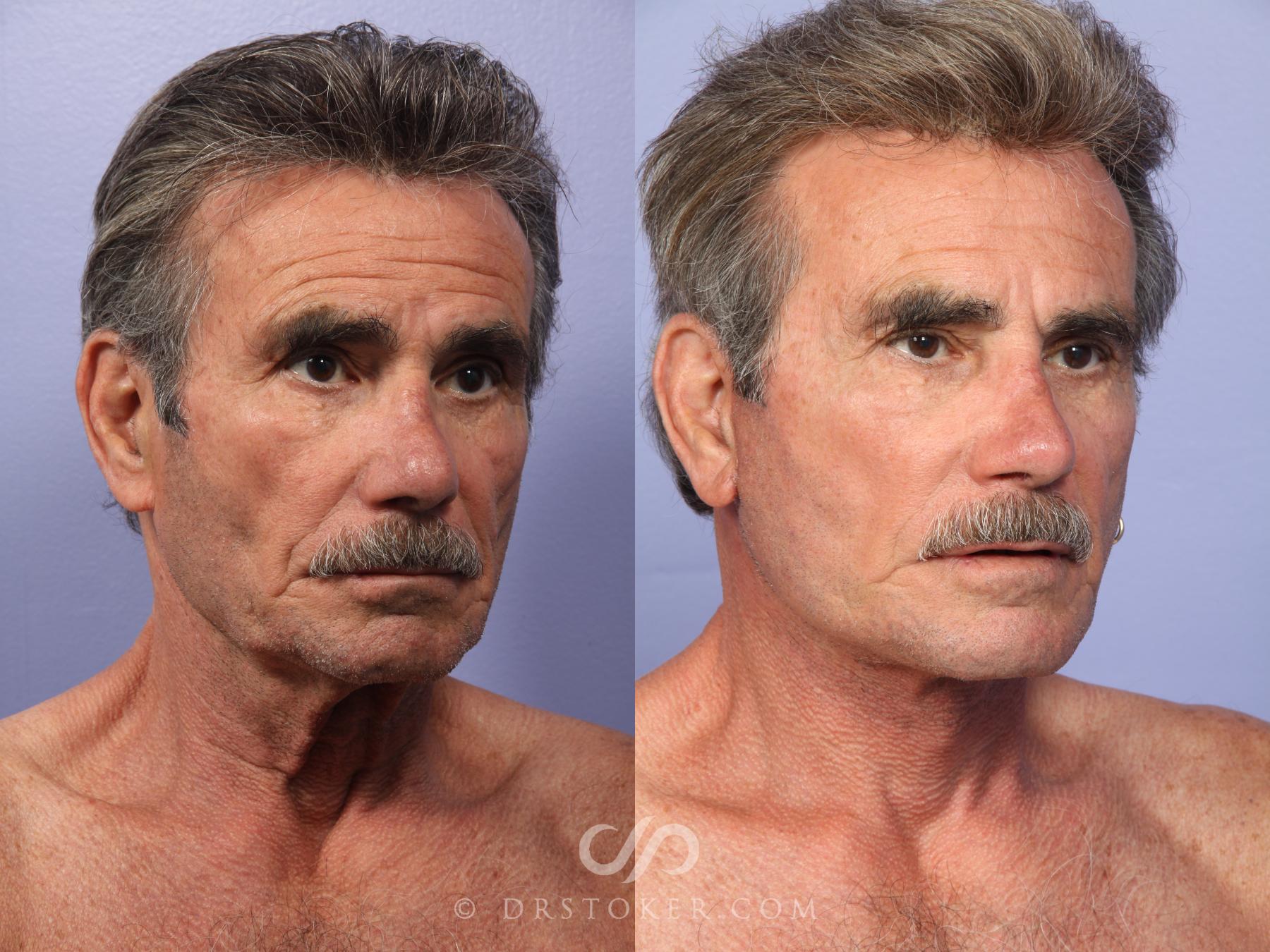 Before & After Facelift/Neck Lift (Deep Plane/Traceless) Case 2128 Right Oblique View in Los Angeles, CA