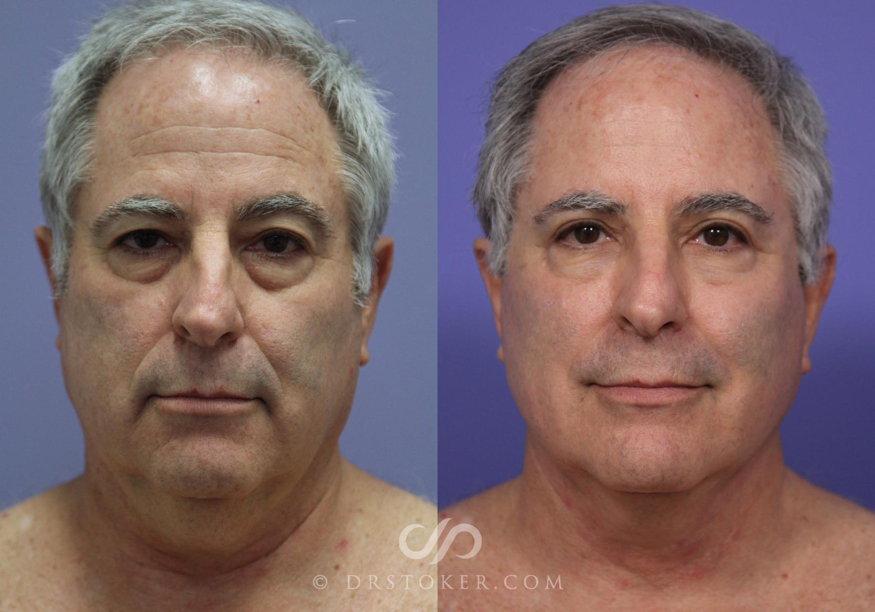 Before & After Facelift/Neck Lift (Deep Plane/Traceless) Case 2129 Front View in Los Angeles, CA