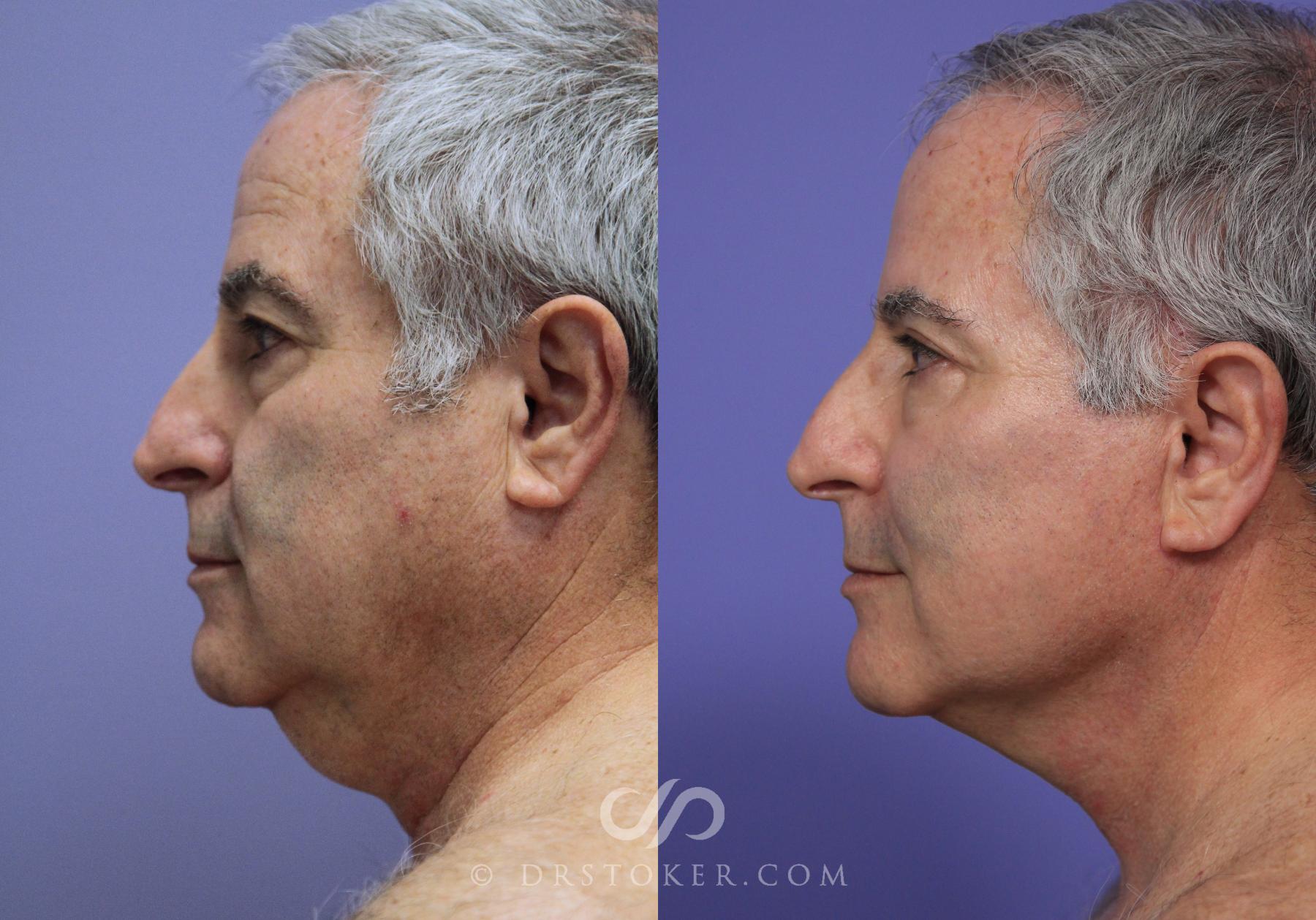 Before & After Facelift/Neck Lift (Deep Plane/Traceless) Case 2129 Left Side View in Los Angeles, CA