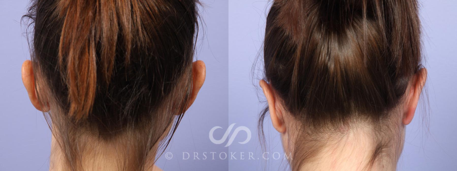 Before & After Ear Surgery Case 373 View #2 View in Los Angeles, CA