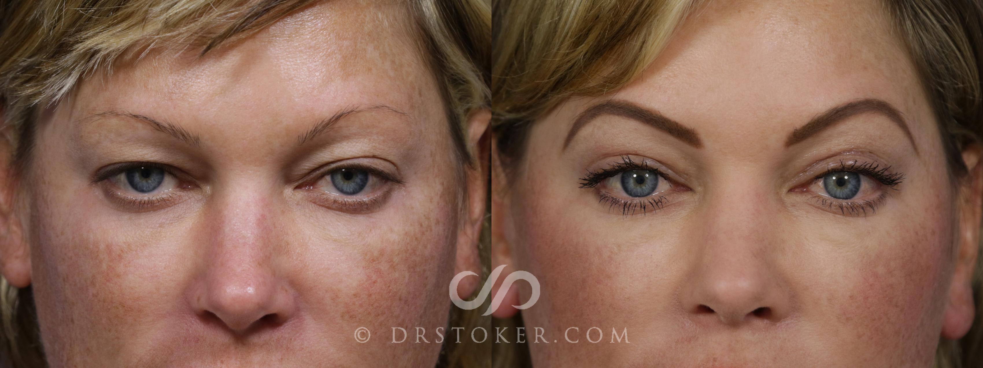 Before & After Eyelid Surgery Case 1296 View #1 View in Los Angeles, CA