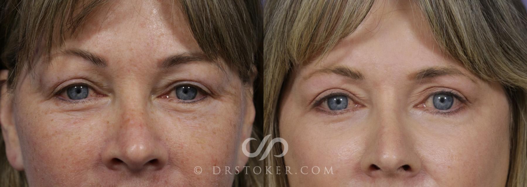 Before & After Eyelid Surgery Case 1297 View #1 View in Los Angeles, CA