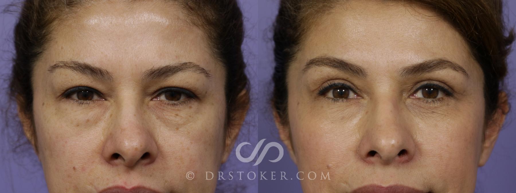 Before & After Eyelid Surgery Case 1368 View #1 View in Los Angeles, CA