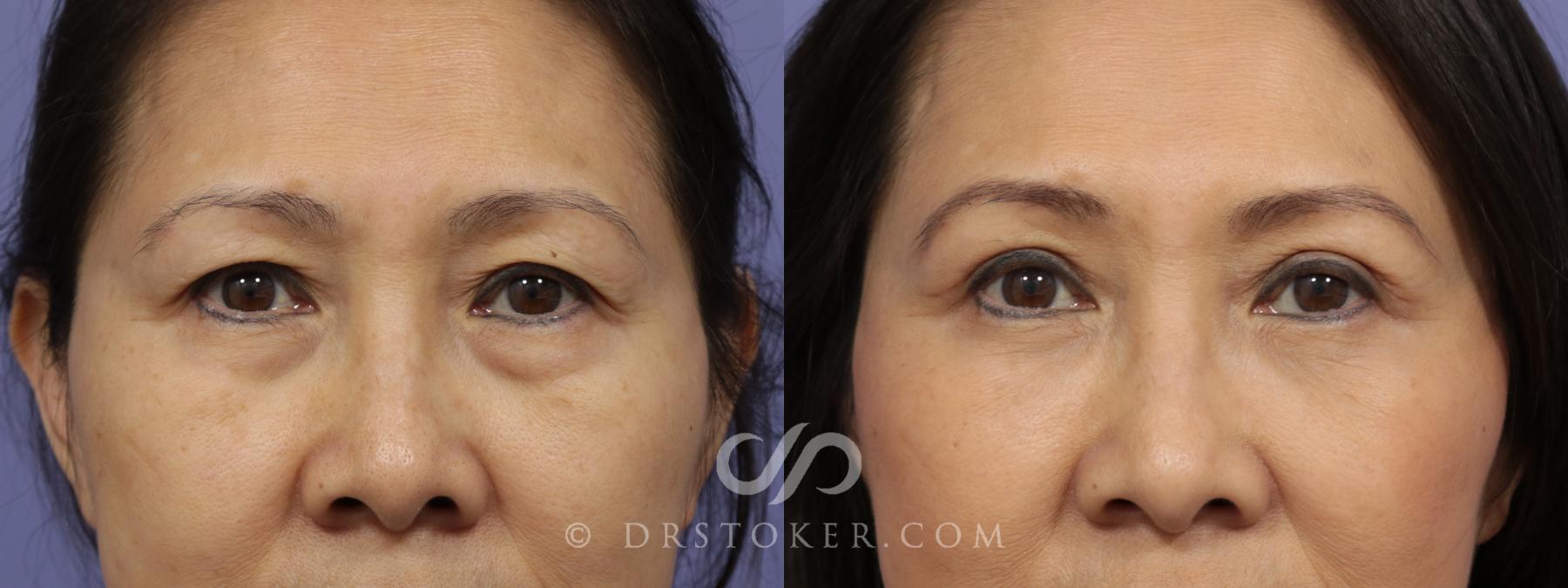Before & After Eyelid Surgery Case 1417 View #1 View in Los Angeles, CA