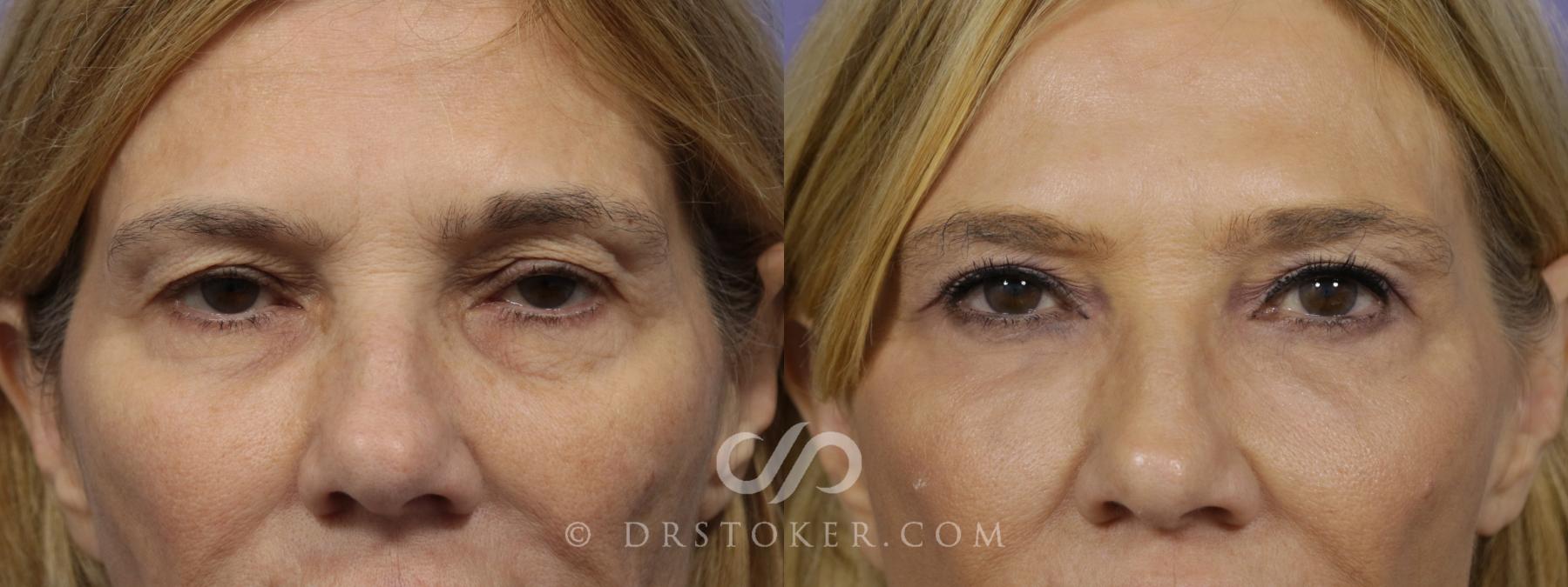 Before & After Eyelid Surgery Case 1419 View #1 View in Los Angeles, CA