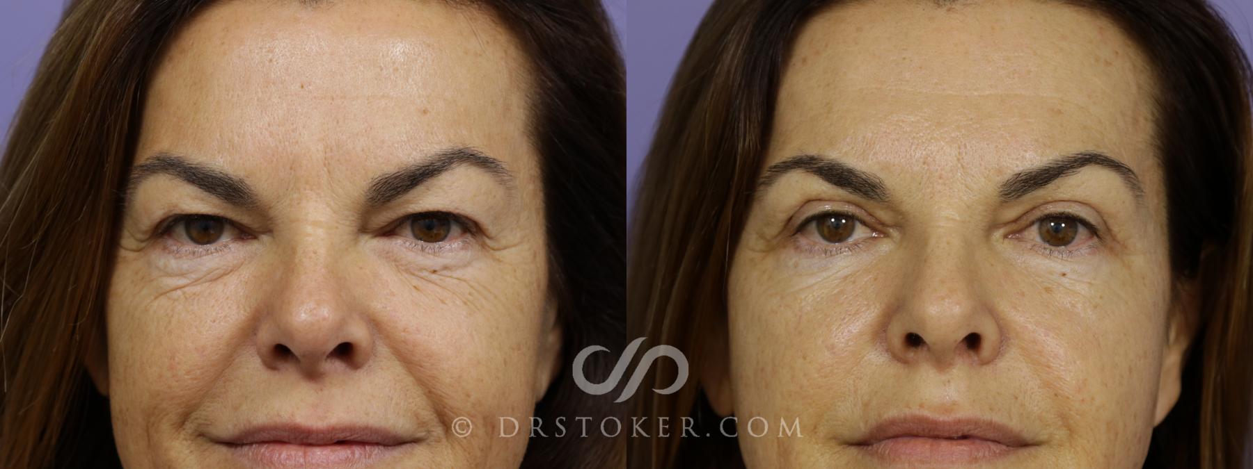 Before & After Eyelid Surgery Case 1420 View #1 View in Los Angeles, CA