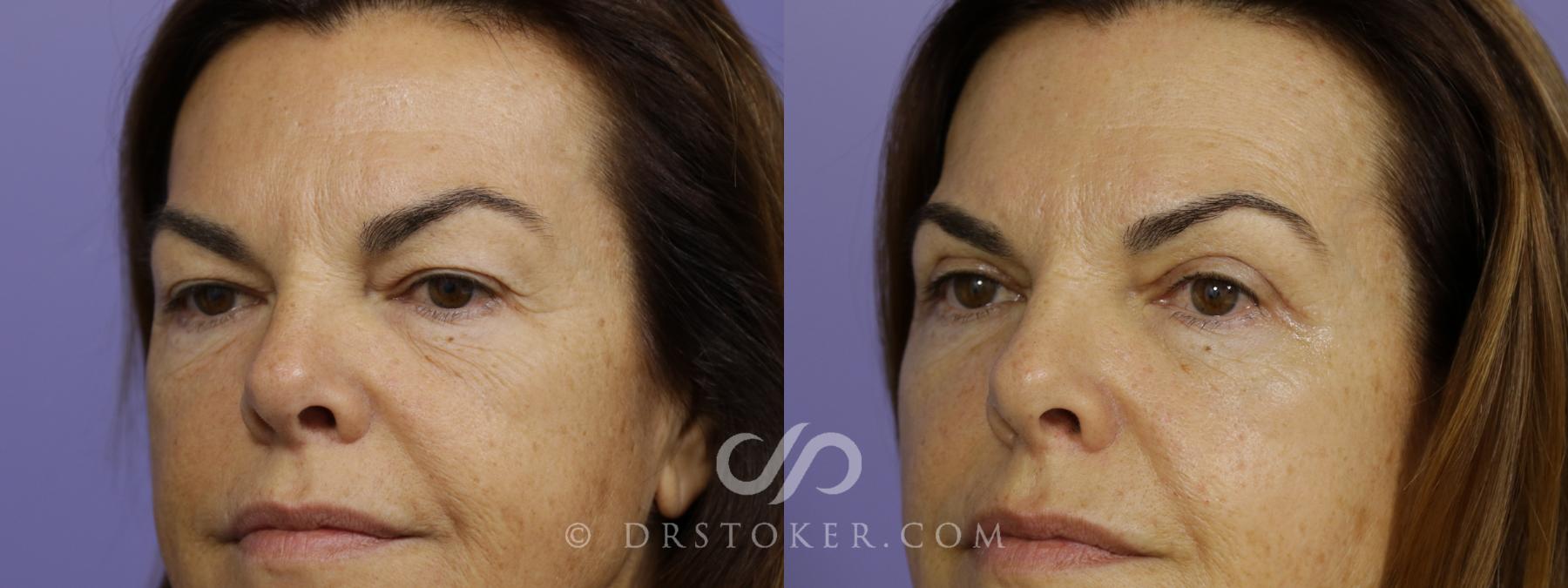 Before & After Eyelid Surgery Case 1420 View #2 View in Los Angeles, CA