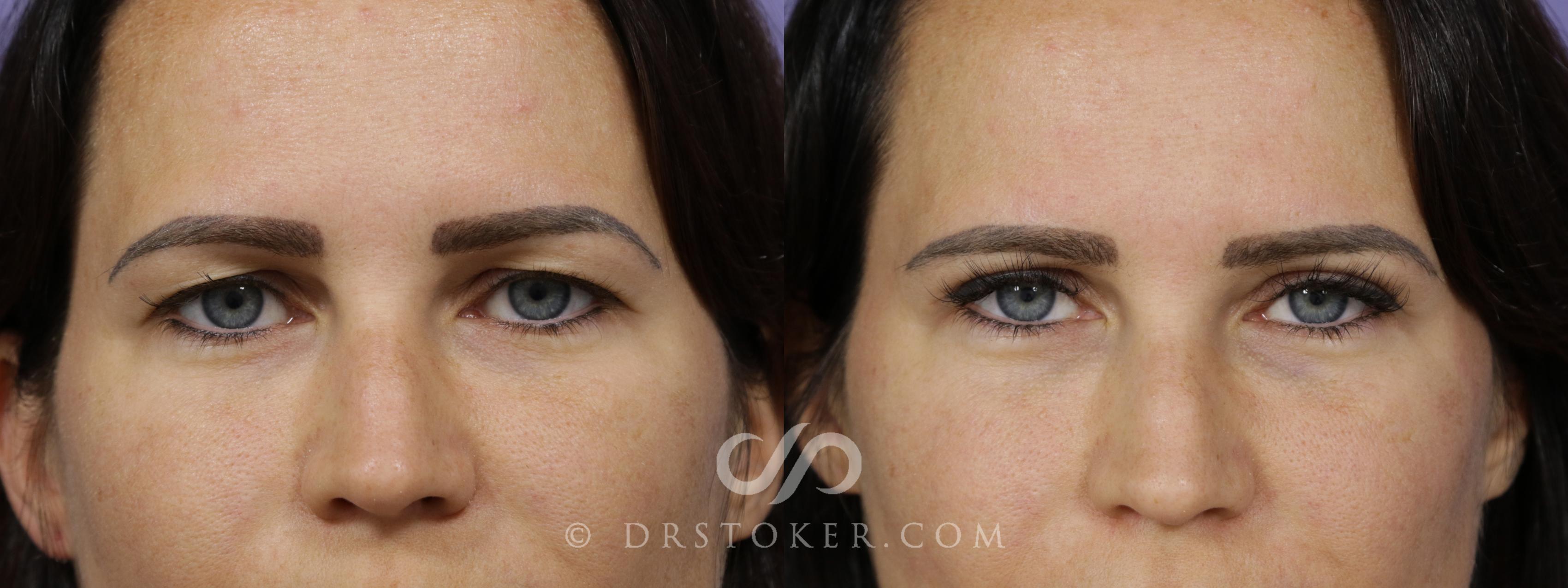Before & After Eyelid Surgery Case 1421 View #1 View in Los Angeles, CA