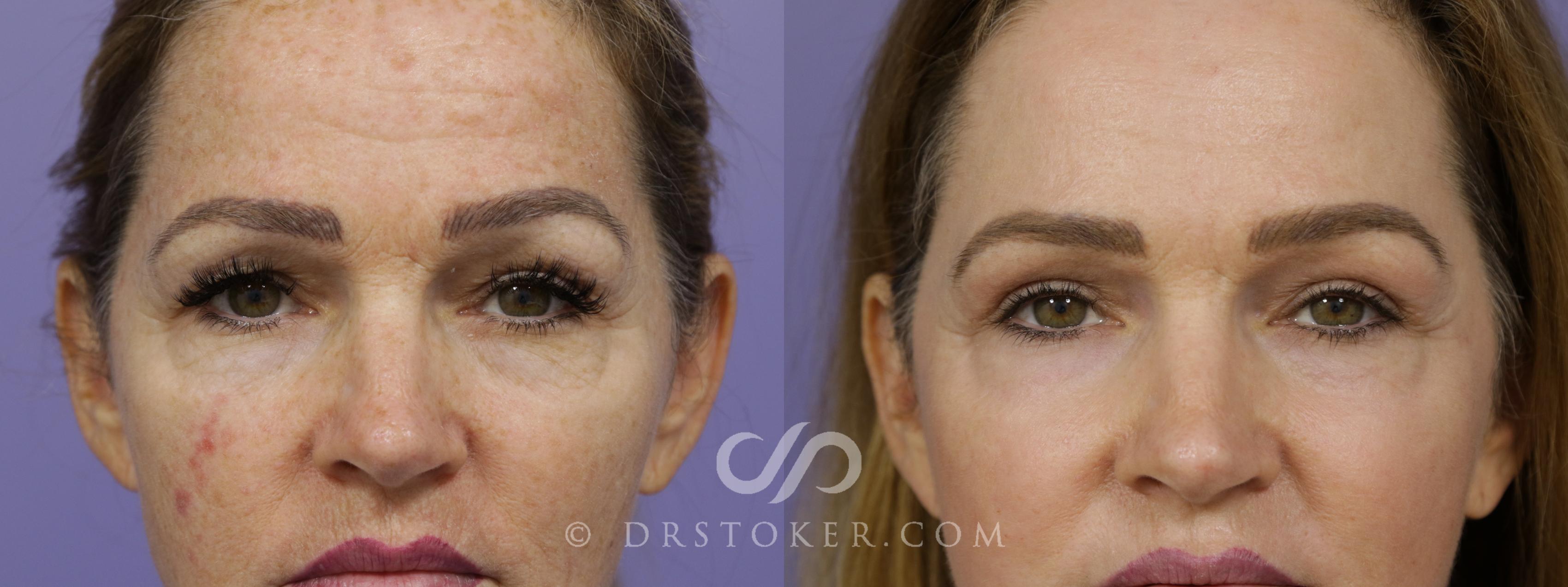 Before & After Eyelid Surgery Case 1422 View #1 View in Los Angeles, CA