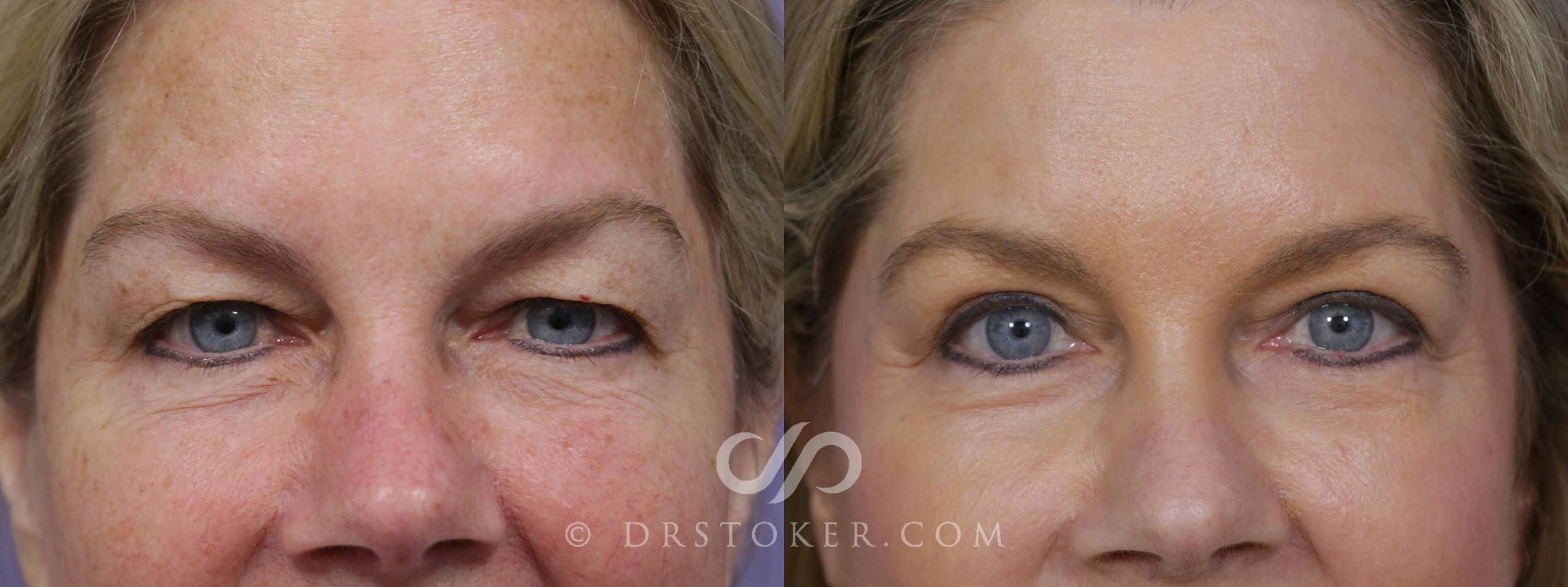 Before & After Eyelid Surgery Case 1423 View #1 View in Los Angeles, CA