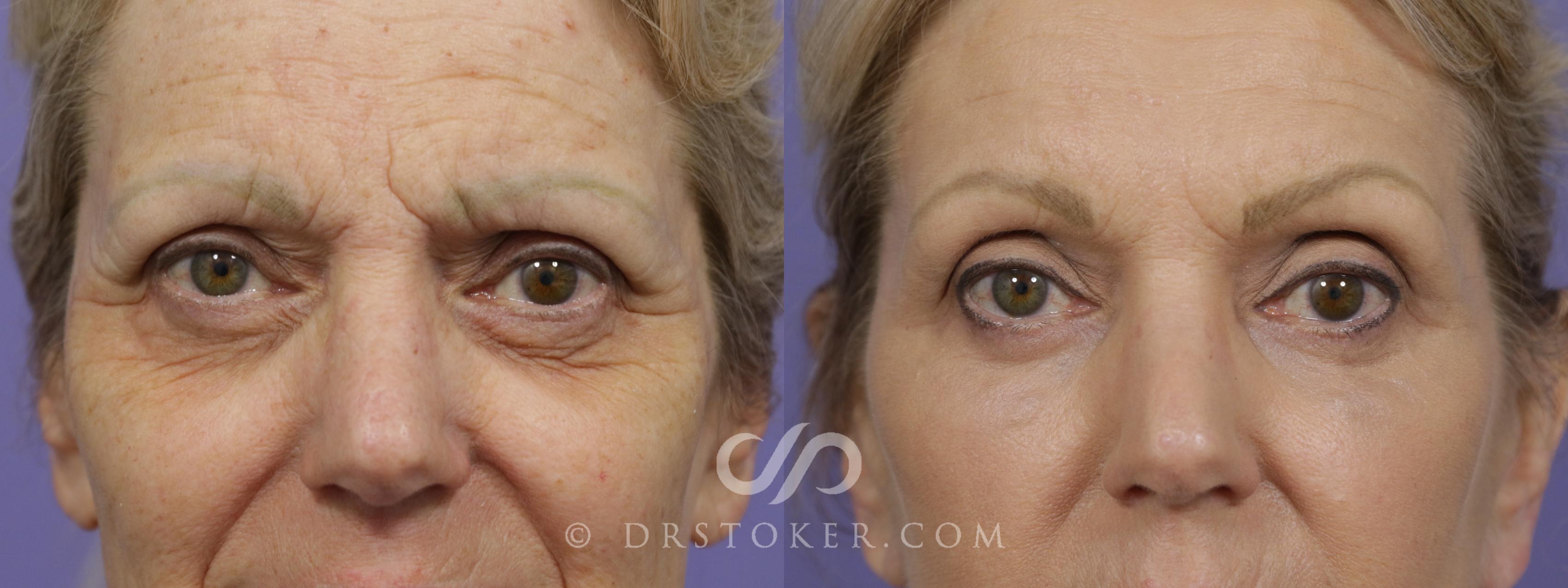 Before & After Eyelid Surgery Case 1425 View #1 View in Los Angeles, CA