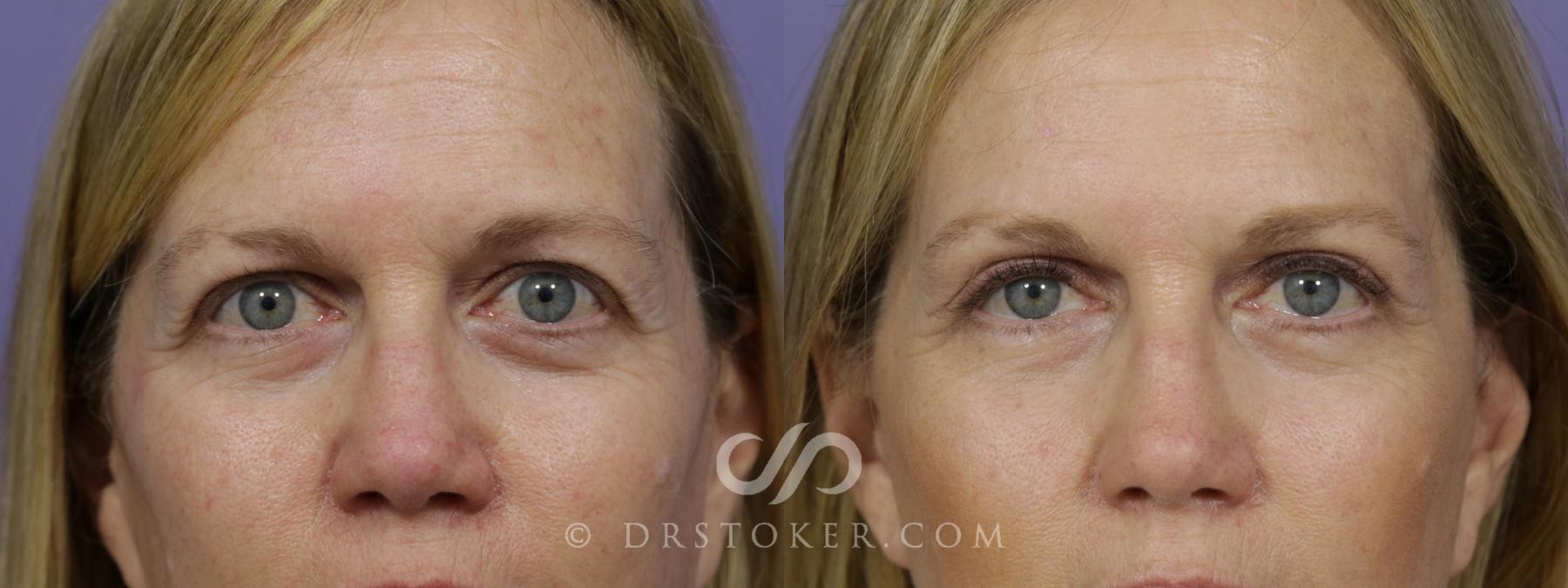 Before & After Eyelid Surgery Case 1468 View #1 View in Los Angeles, CA