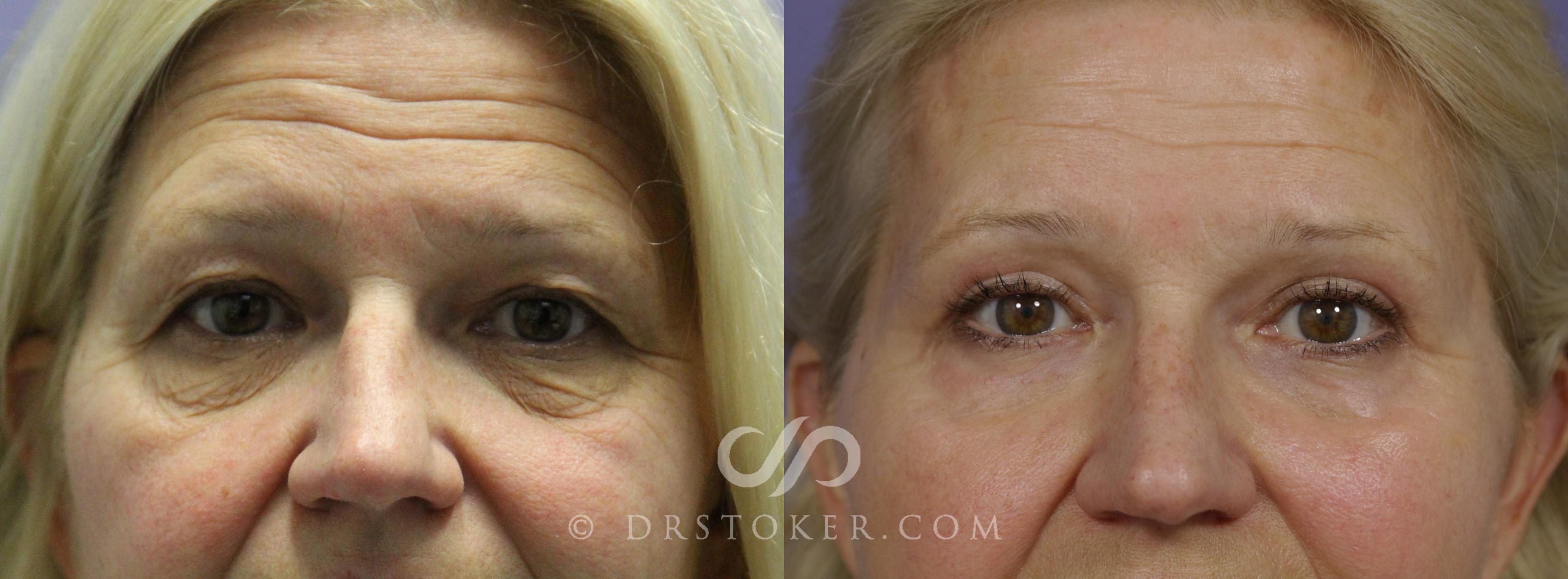 Before & After Eyelid Surgery Case 1498 View #1 View in Los Angeles, CA