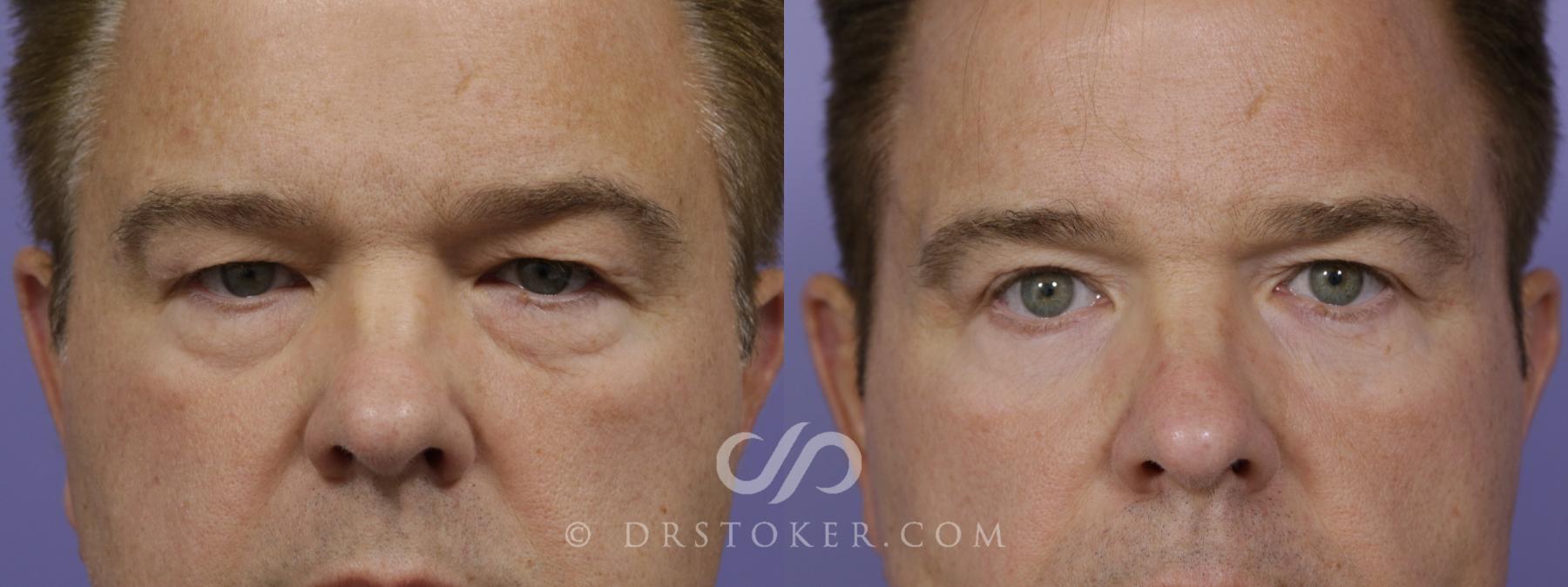 Before & After Undereye Fillers Case 1525 View #1 View in Los Angeles, CA