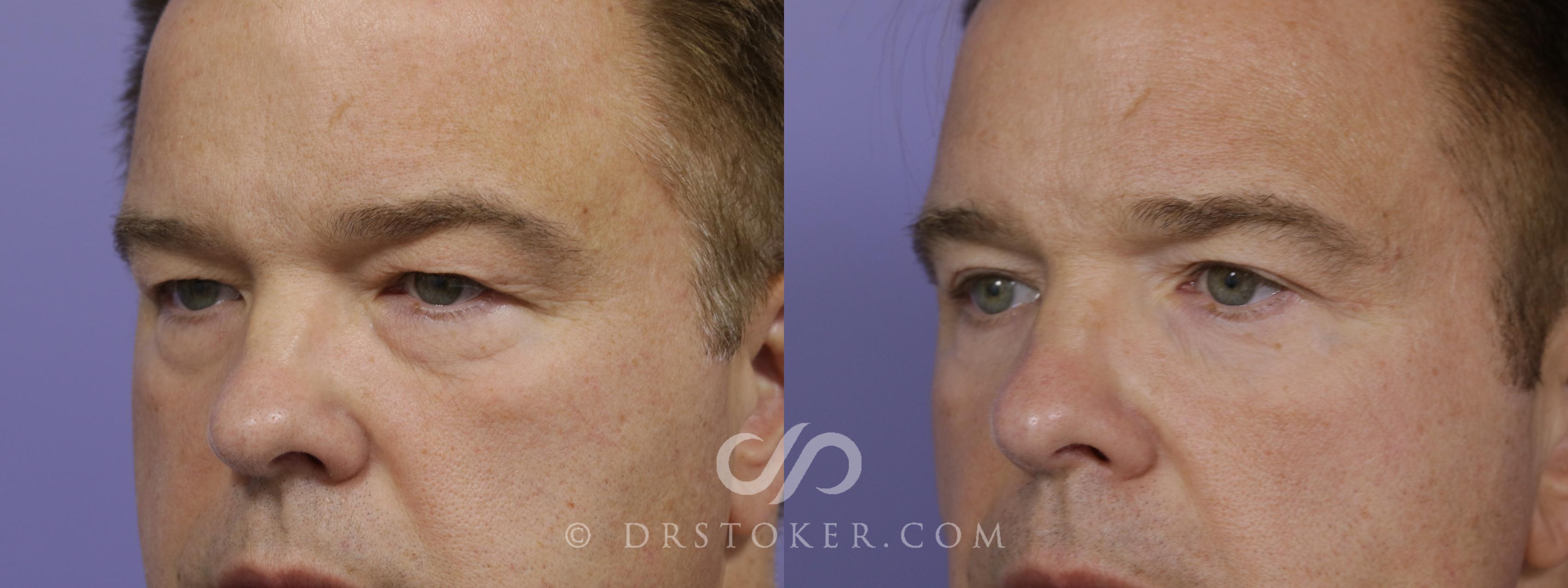 Before & After Undereye Fillers Case 1525 View #2 View in Los Angeles, CA