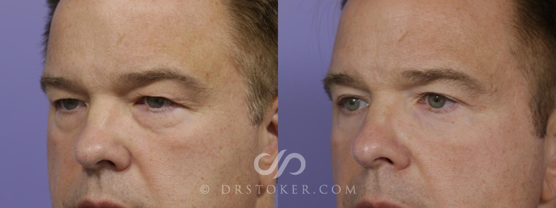Before & After Undereye Fillers Case 1525 View #2 View in Los Angeles, CA