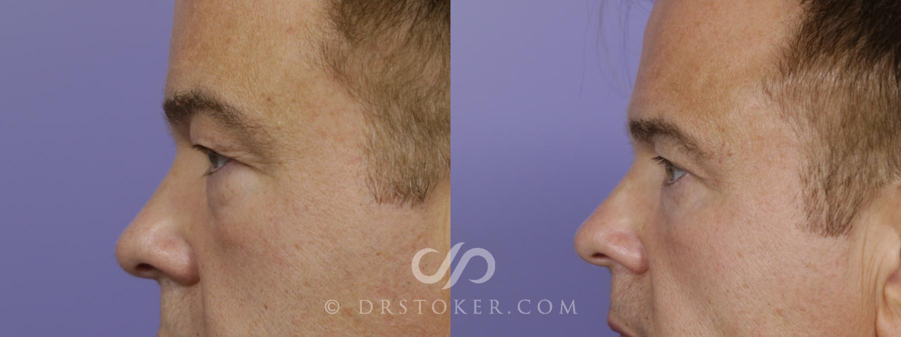 Before & After Undereye Fillers Case 1525 View #3 View in Los Angeles, CA