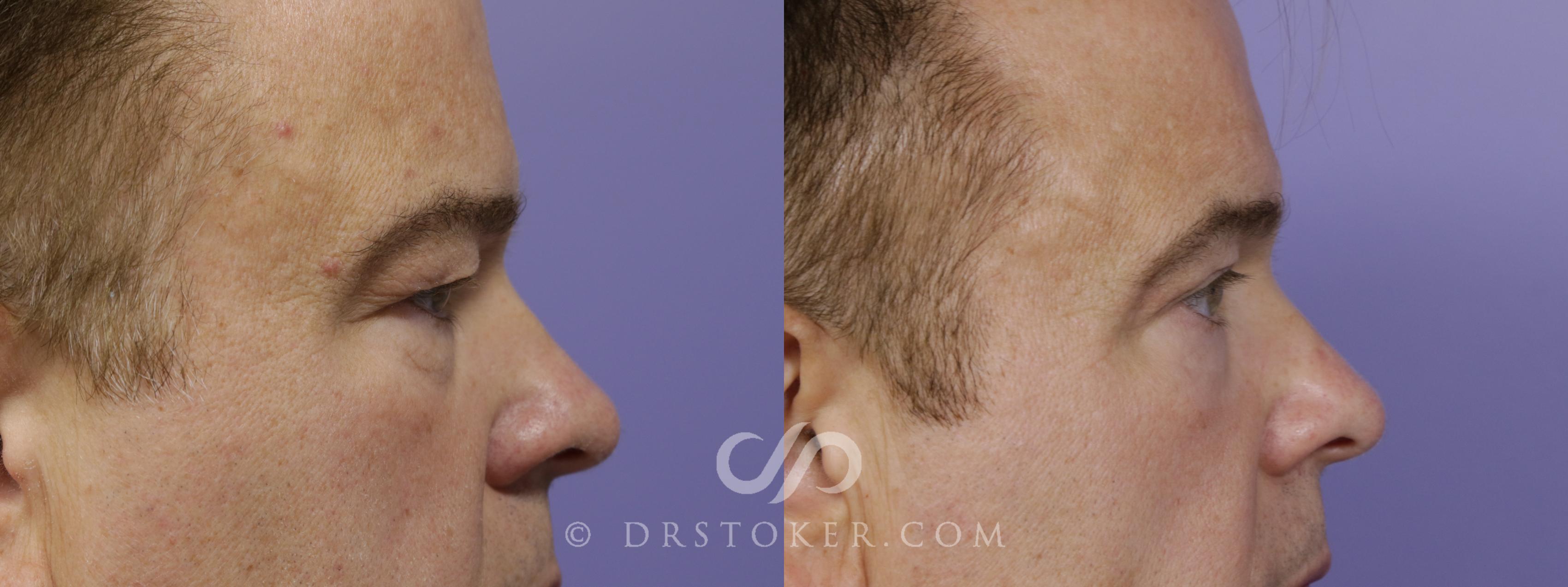 Before & After Undereye Fillers Case 1525 View #4 View in Los Angeles, CA