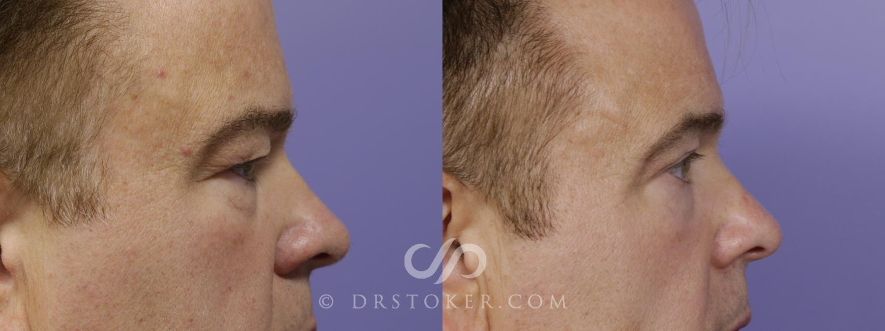 Before & After Undereye Fillers Case 1525 View #4 View in Los Angeles, CA