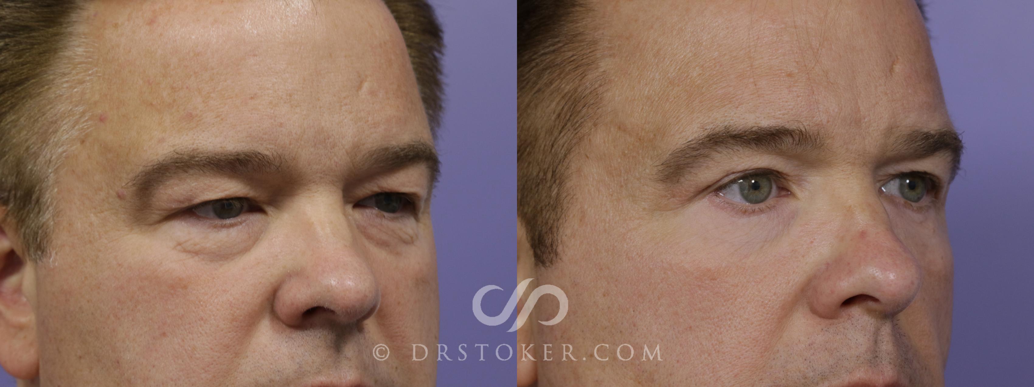 Before & After Eyelid Surgery Case 1525 View #5 View in Los Angeles, CA