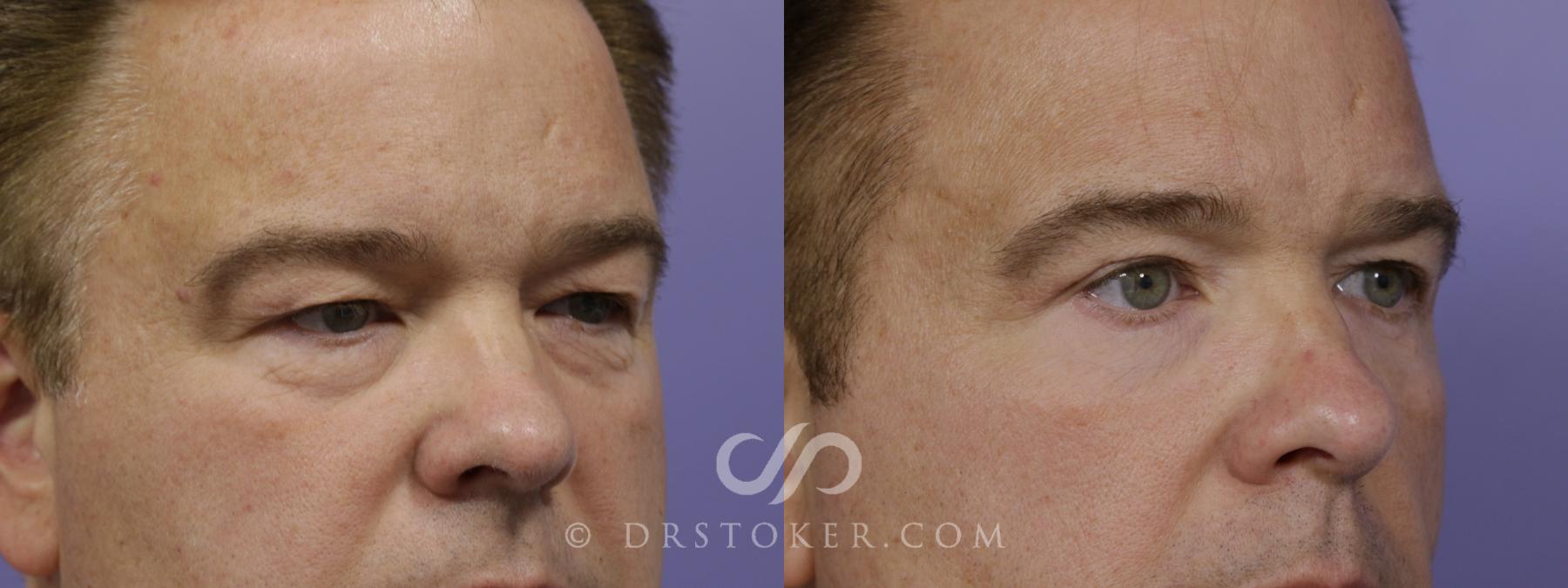 Before & After Eyelid Surgery for Men Case 1525 View #5 View in Los Angeles, CA