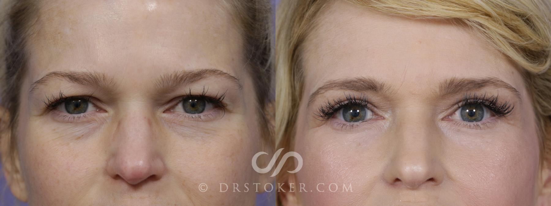 Before & After Eyelid Surgery Case 1526 View #1 View in Los Angeles, CA