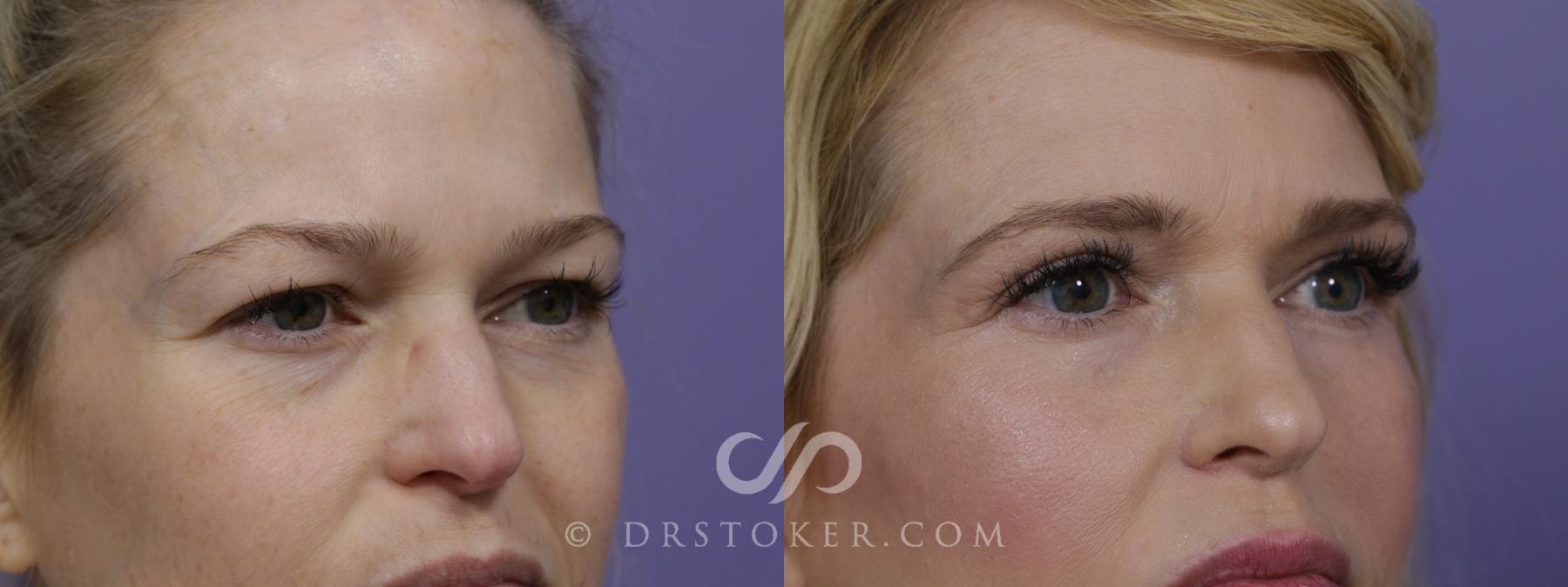 Before & After Eyelid Surgery Case 1526 View #2 View in Los Angeles, CA