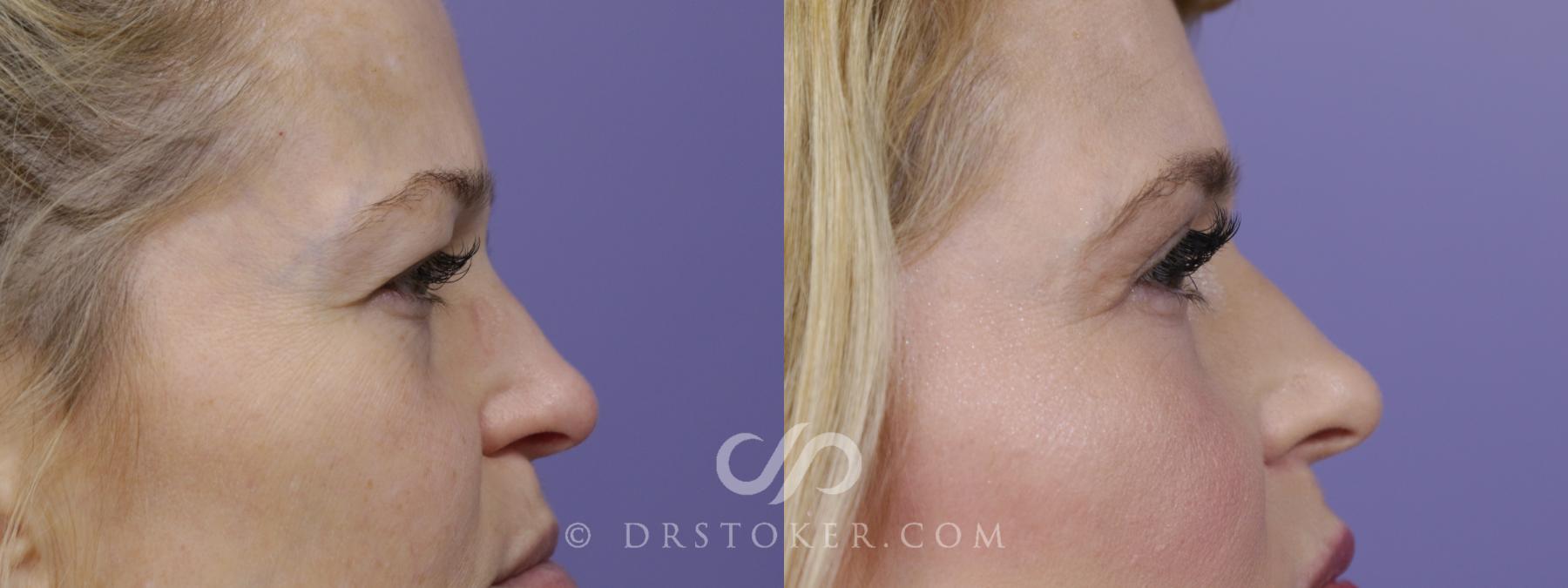 Before & After Eyelid Surgery Case 1526 View #3 View in Los Angeles, CA