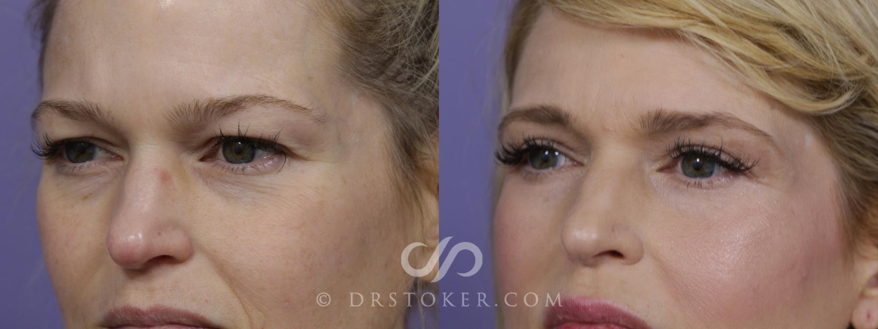 Before & After Eyelid Surgery Case 1526 View #4 View in Los Angeles, CA