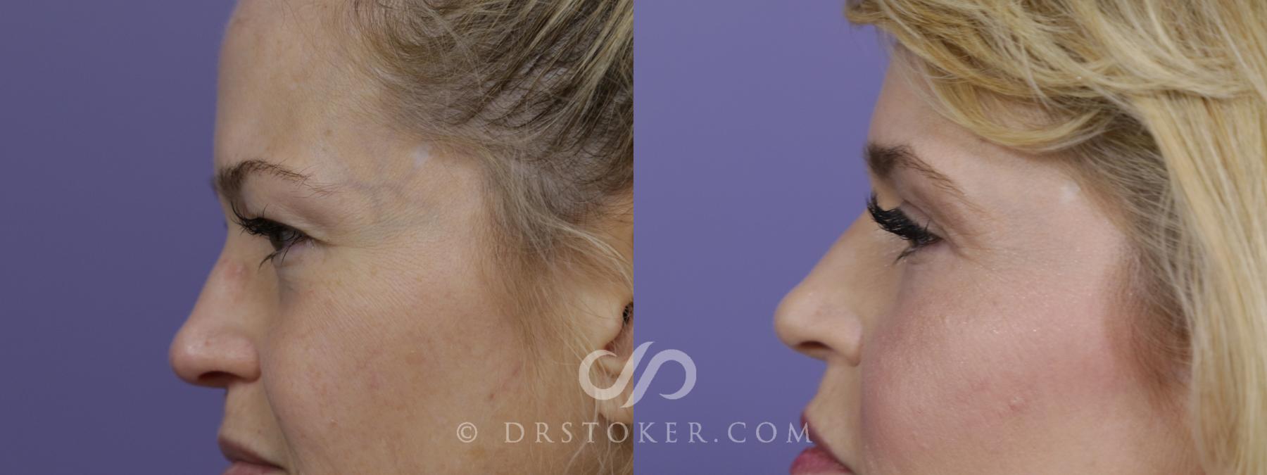 Before & After Eyelid Surgery Case 1526 View #5 View in Los Angeles, CA