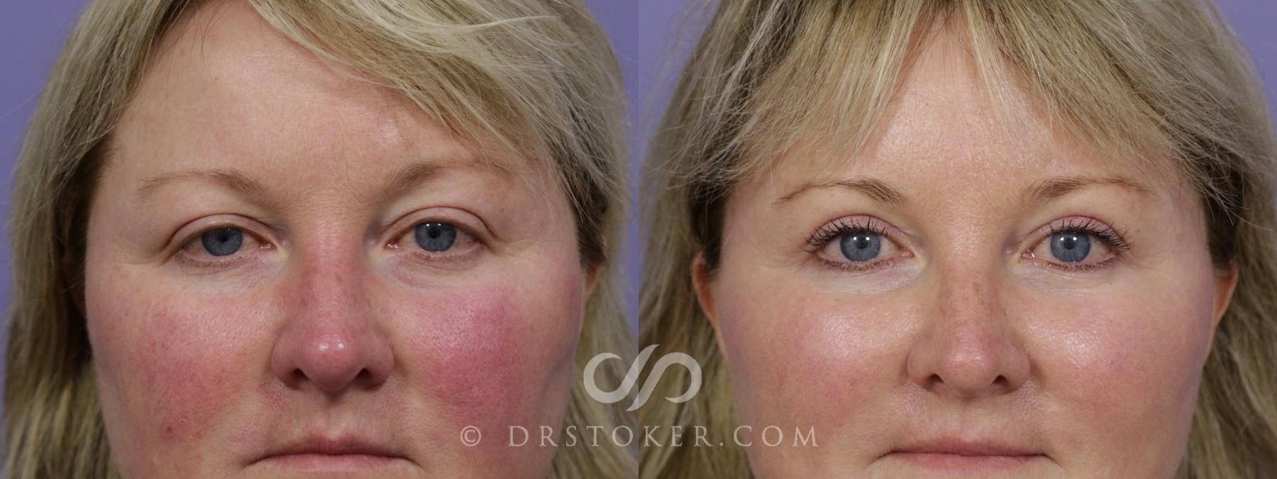 Before & After Eyelid Surgery Case 1527 View #1 View in Los Angeles, CA