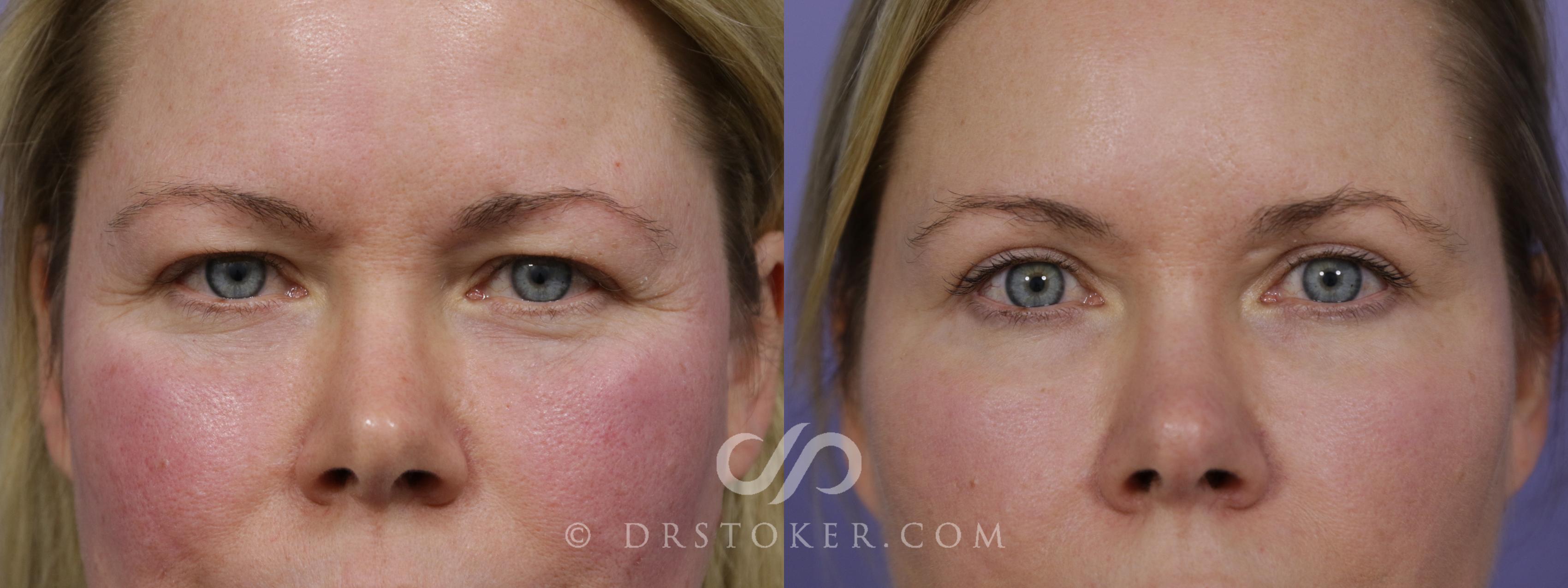 Before & After Eyelid Surgery Case 1529 View #1 View in Los Angeles, CA