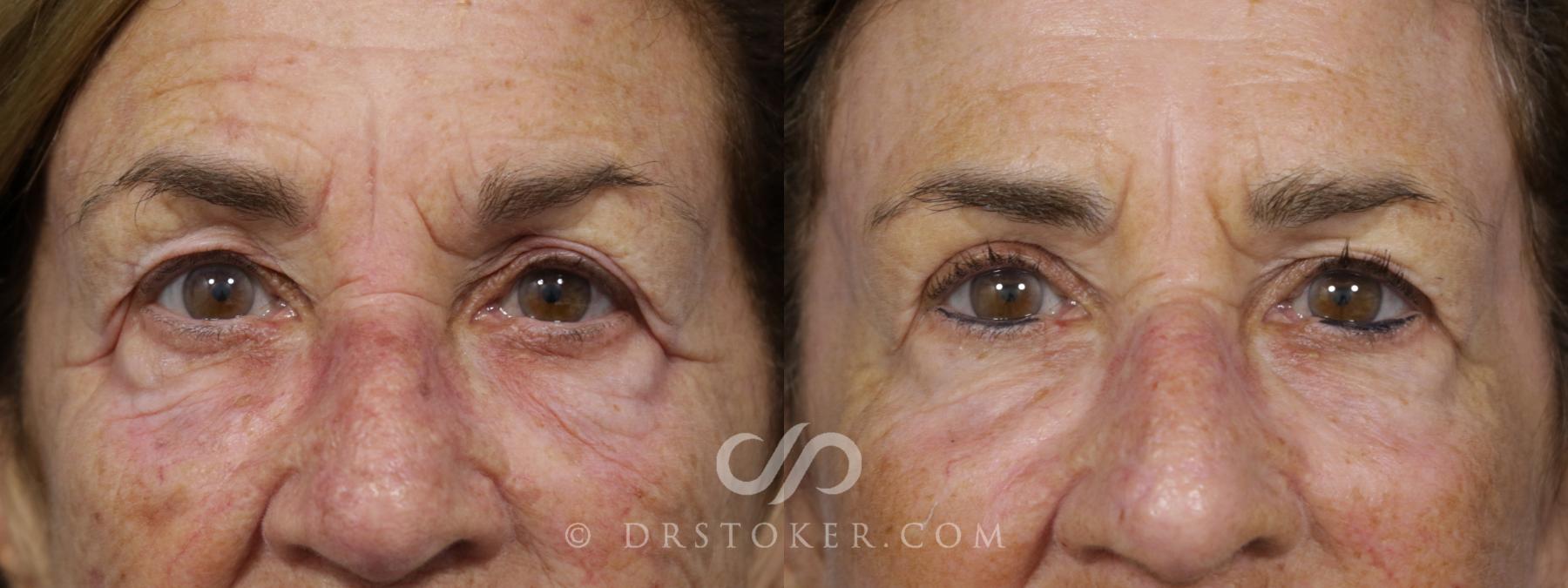 Before & After Eyelid Surgery Case 1534 View #1 View in Los Angeles, CA