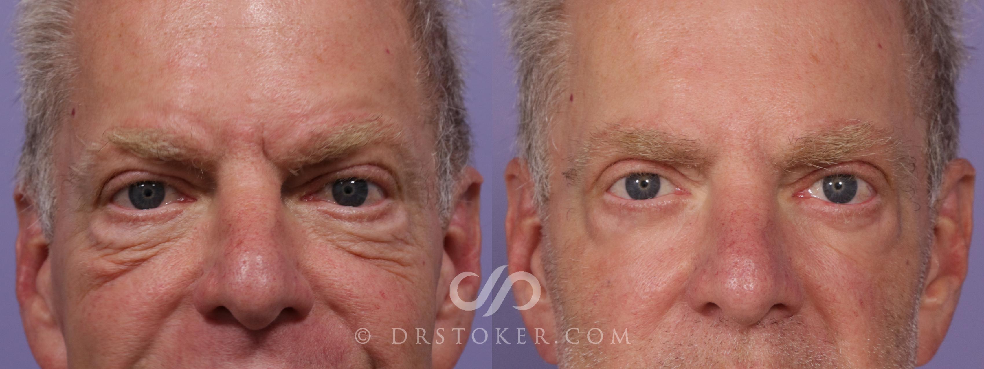 Before & After Eyelid Surgery Case 1732 View #1 View in Los Angeles, CA