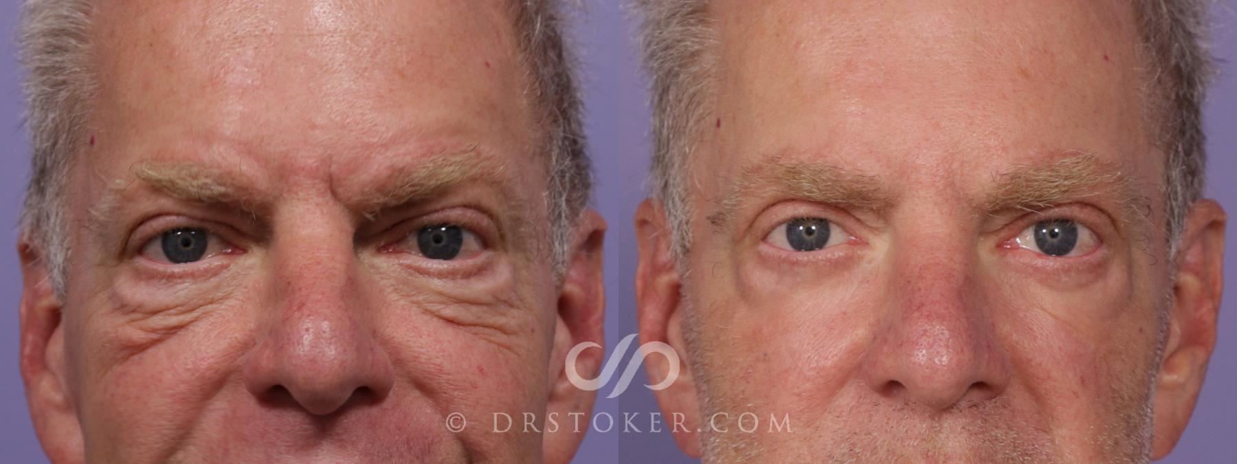 Before & After Eyelid Surgery for Men Case 1732 View #1 View in Los Angeles, CA