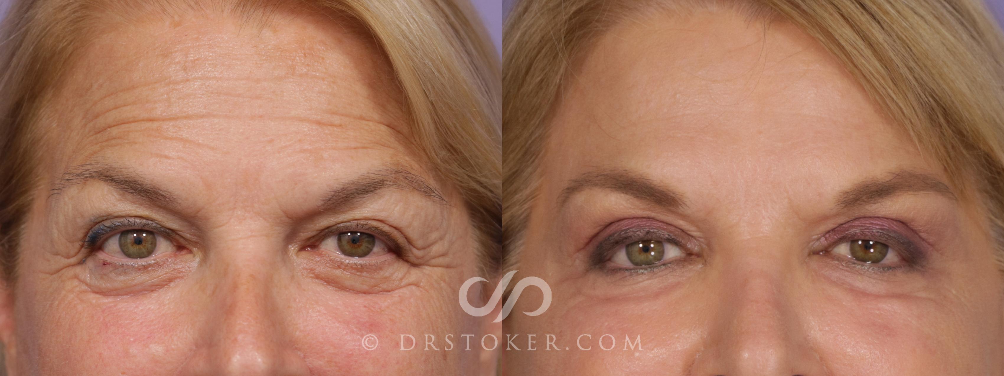 Before & After Eyelid Surgery Case 1738 View #1 View in Marina del Rey, CA