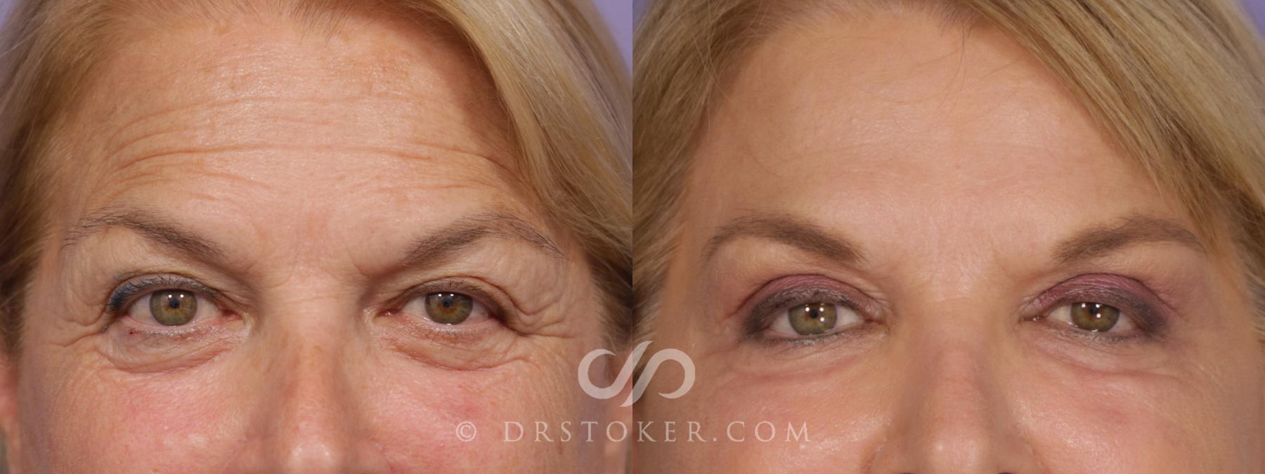 Before & After Laser Skin Resurfacing Case 1738 View #1 View in Los Angeles, CA