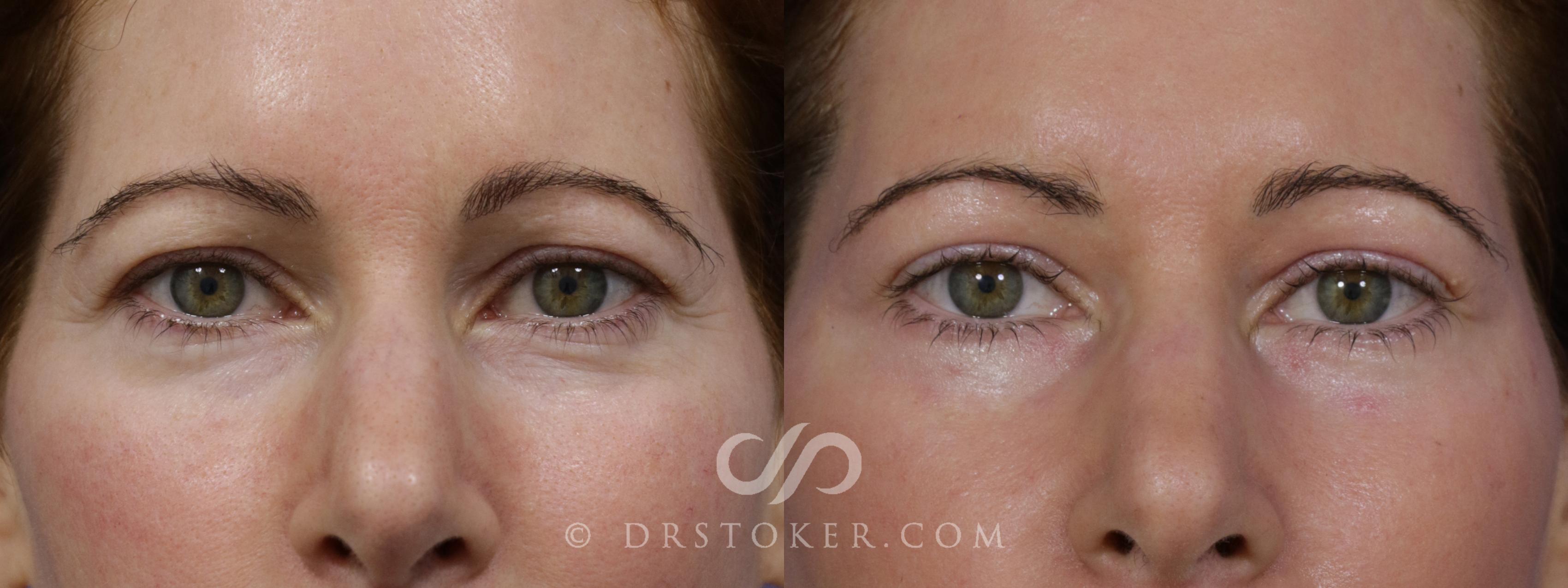Before & After Eyelid Surgery Case 1776 View #1 View in Los Angeles, CA