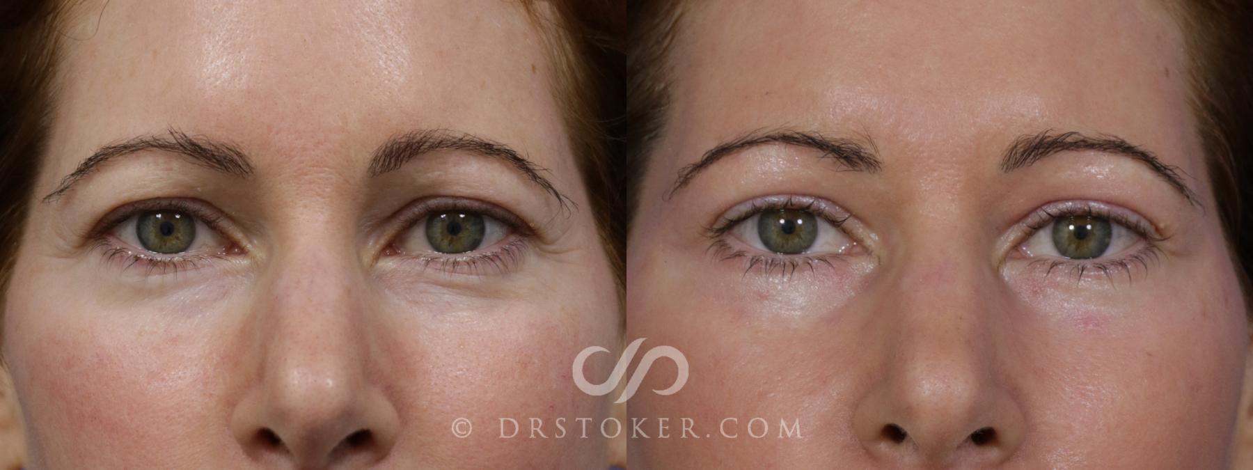 Before & After Eyelid Surgery Case 1776 View #1 View in Los Angeles, CA