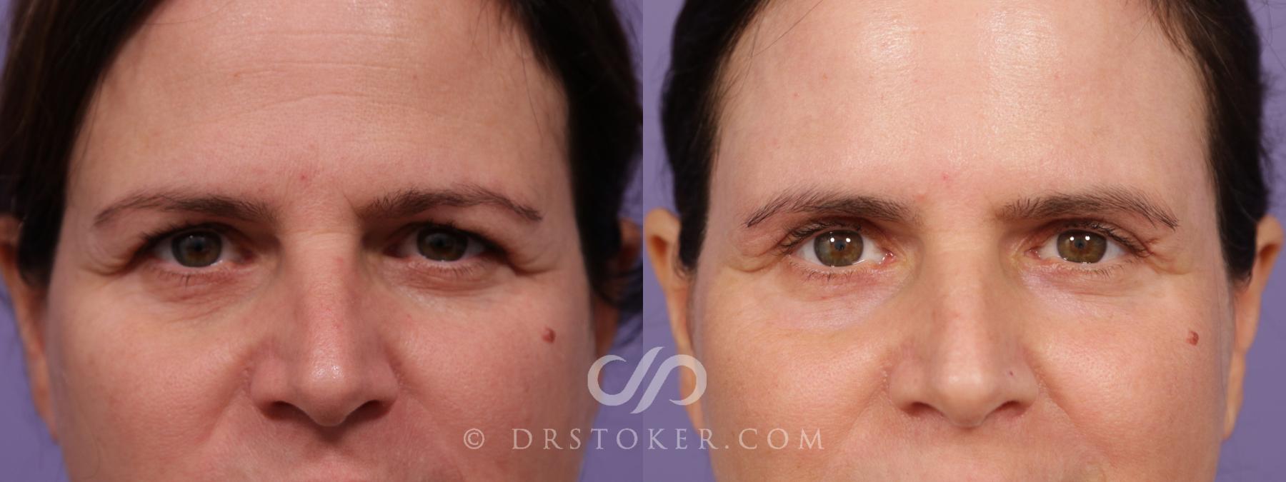 Before & After Eyelid Surgery Case 1780 View #1 View in Los Angeles, CA