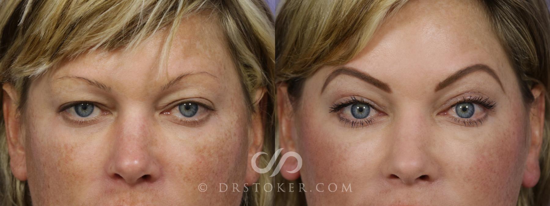 Before & After Eyelid Surgery Case 1781 View #1 View in Los Angeles, CA