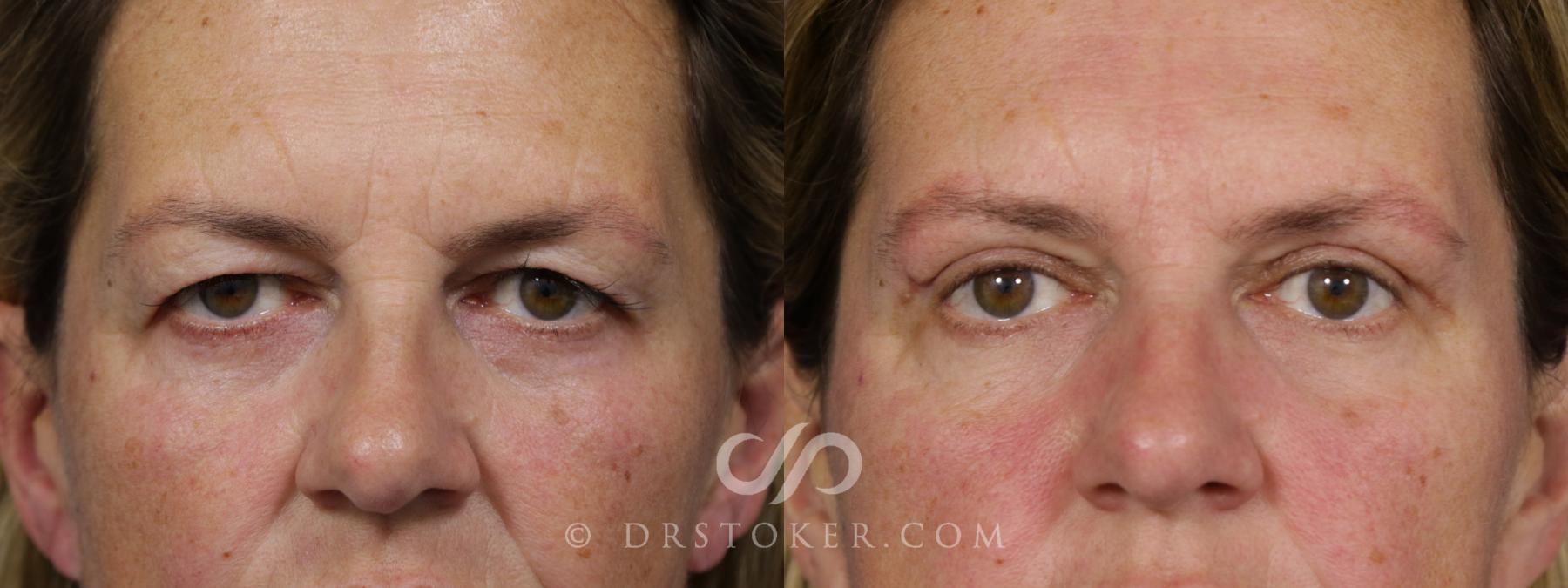 Before & After Eyelid Surgery Case 1782 View #1 View in Los Angeles, CA