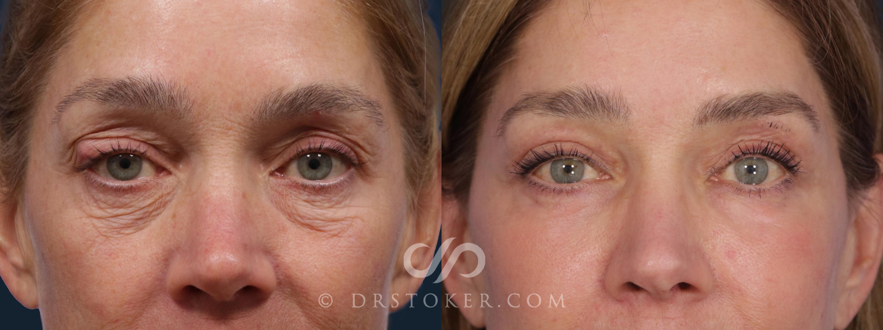 Before & After Eyelid Surgery Case 1808 Front View in Los Angeles, CA