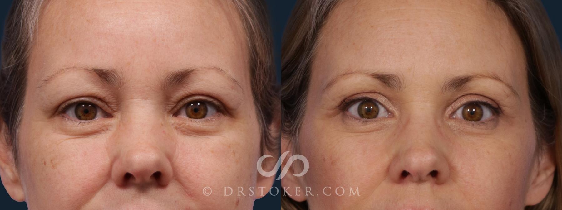 Before & After Eyelid Surgery Case 1809 Front View in Los Angeles, CA
