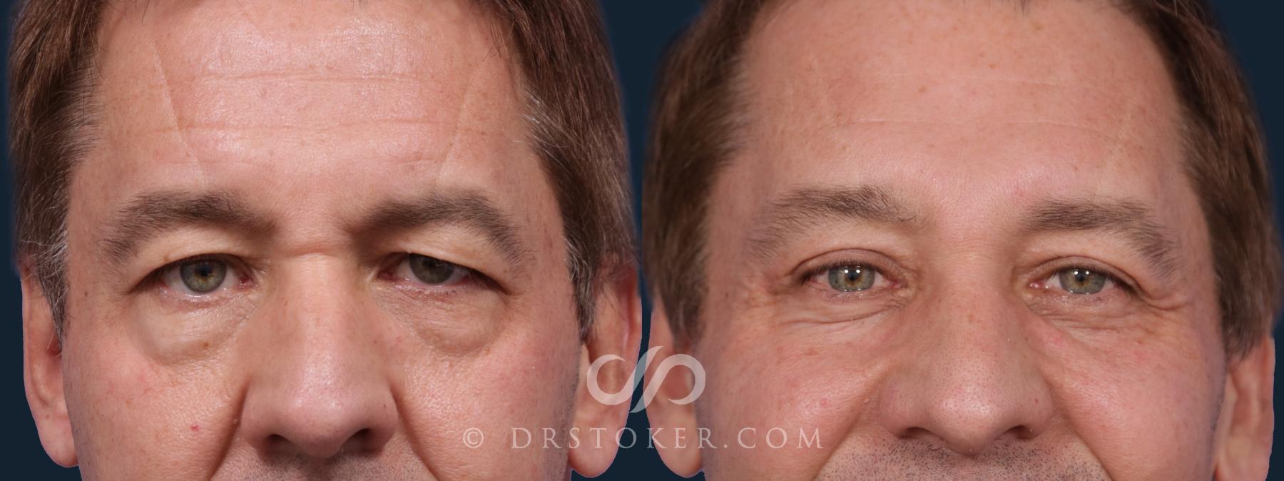 Before & After Eyelid Surgery Case 1874 Front View in Los Angeles, CA